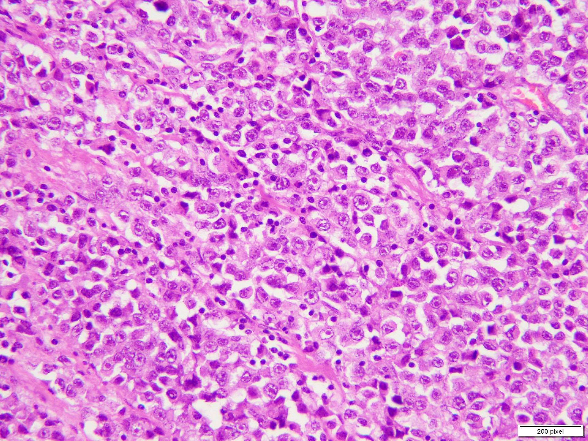 Nonbrisk tumor infiltrating lymphocytes