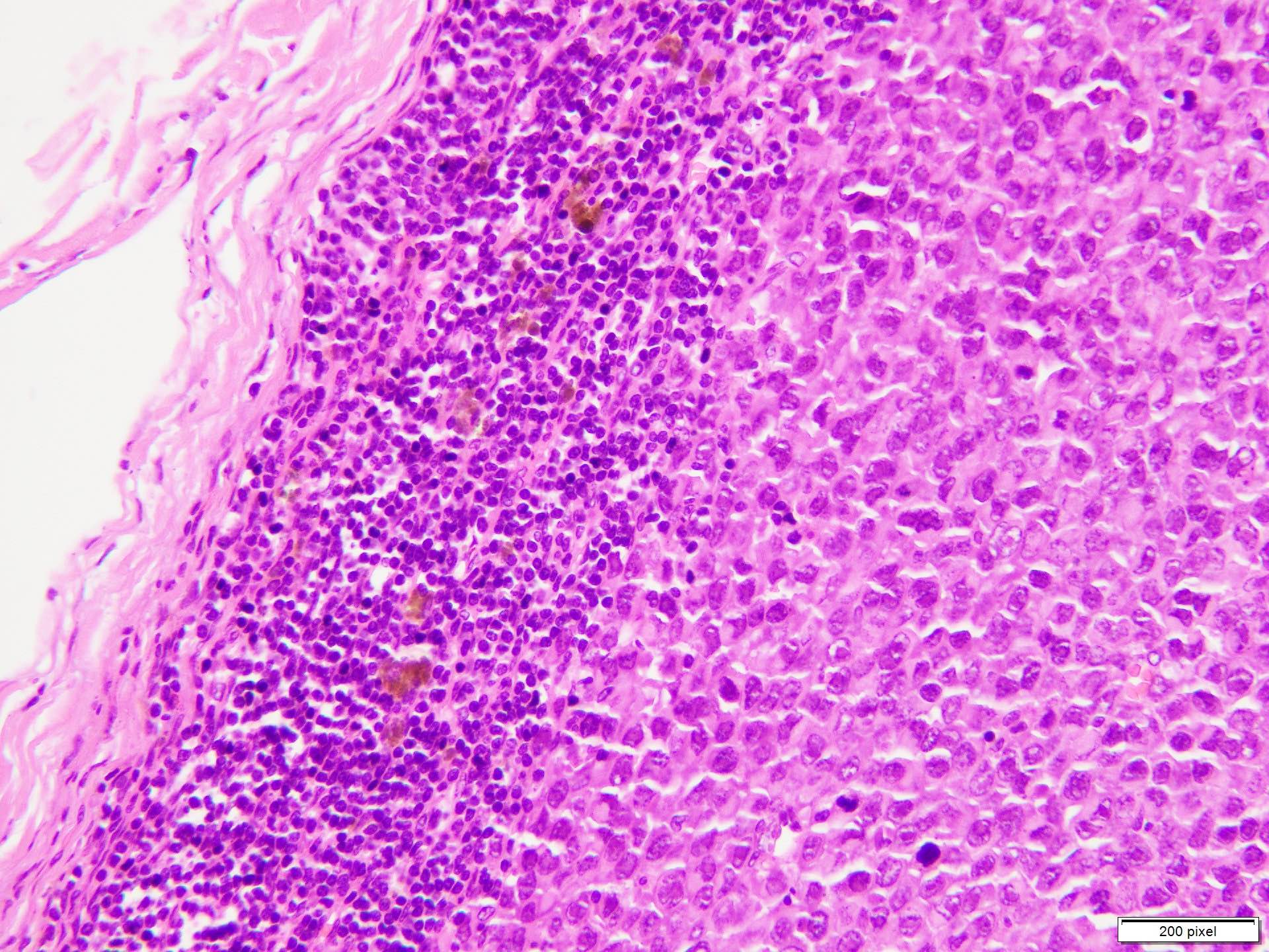 Melanoma metastasis to lymph node