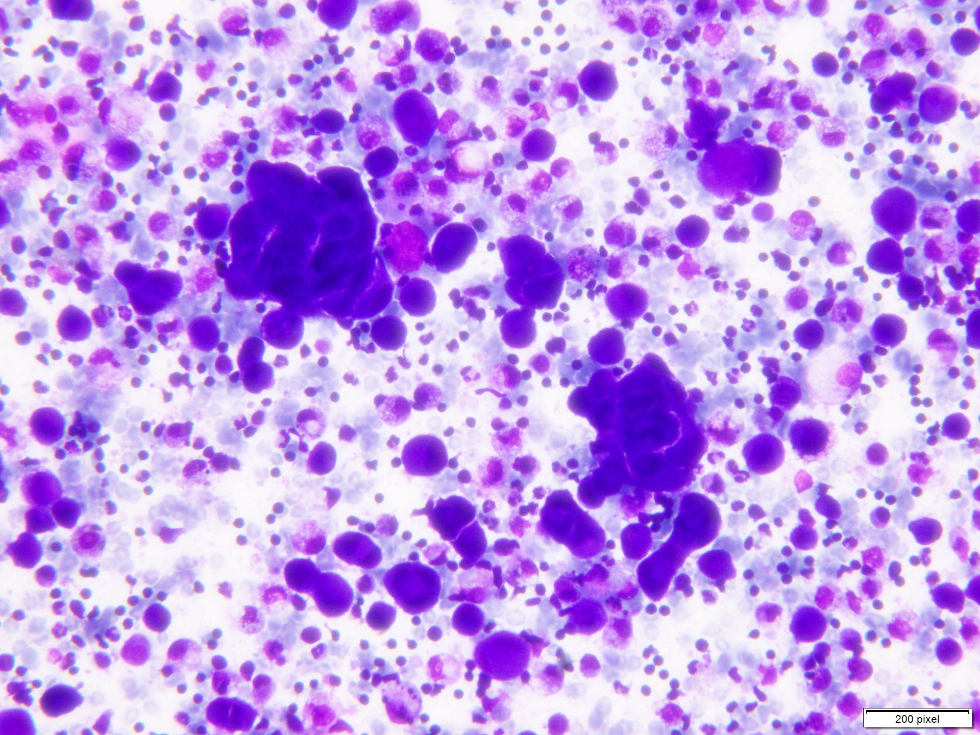 Diff-Quik stained smear