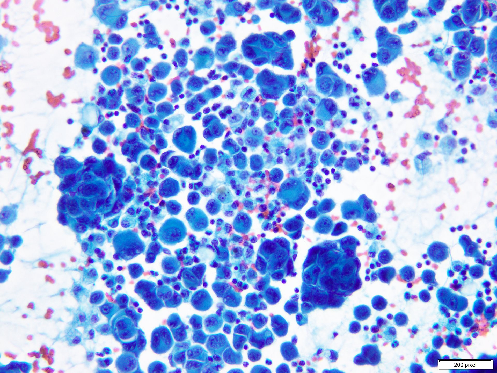 Papanicolaou stained smear