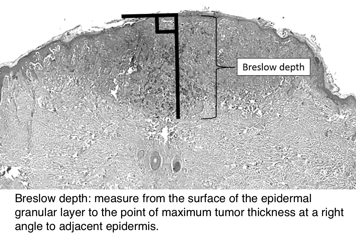 Melanoma Staging Chart