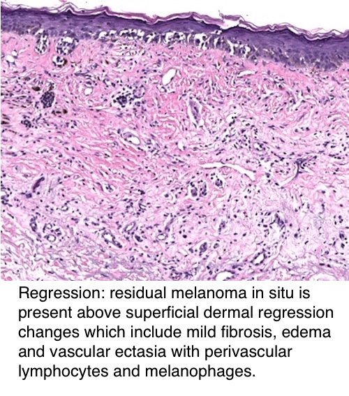 Melanoma Staging Chart