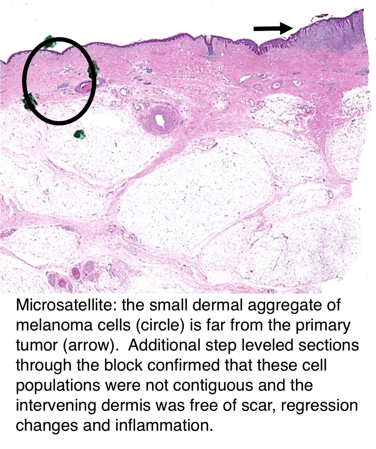 Melanoma Staging Chart