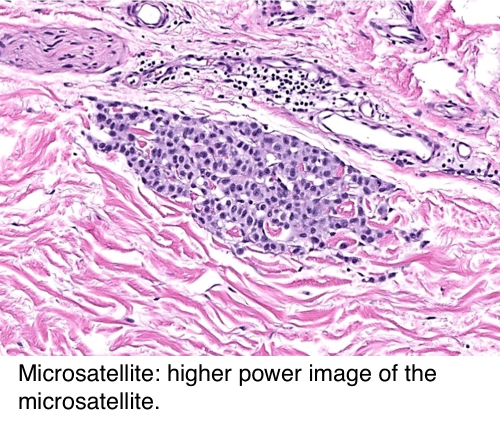 Melanoma Staging Chart