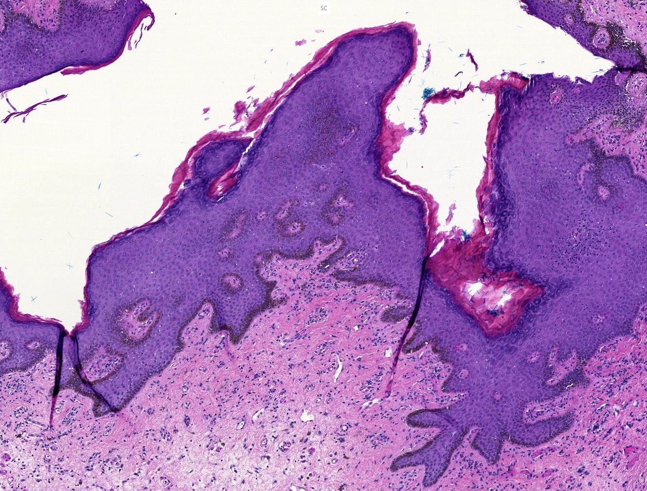 Pathology Outlines - Melanotic macule