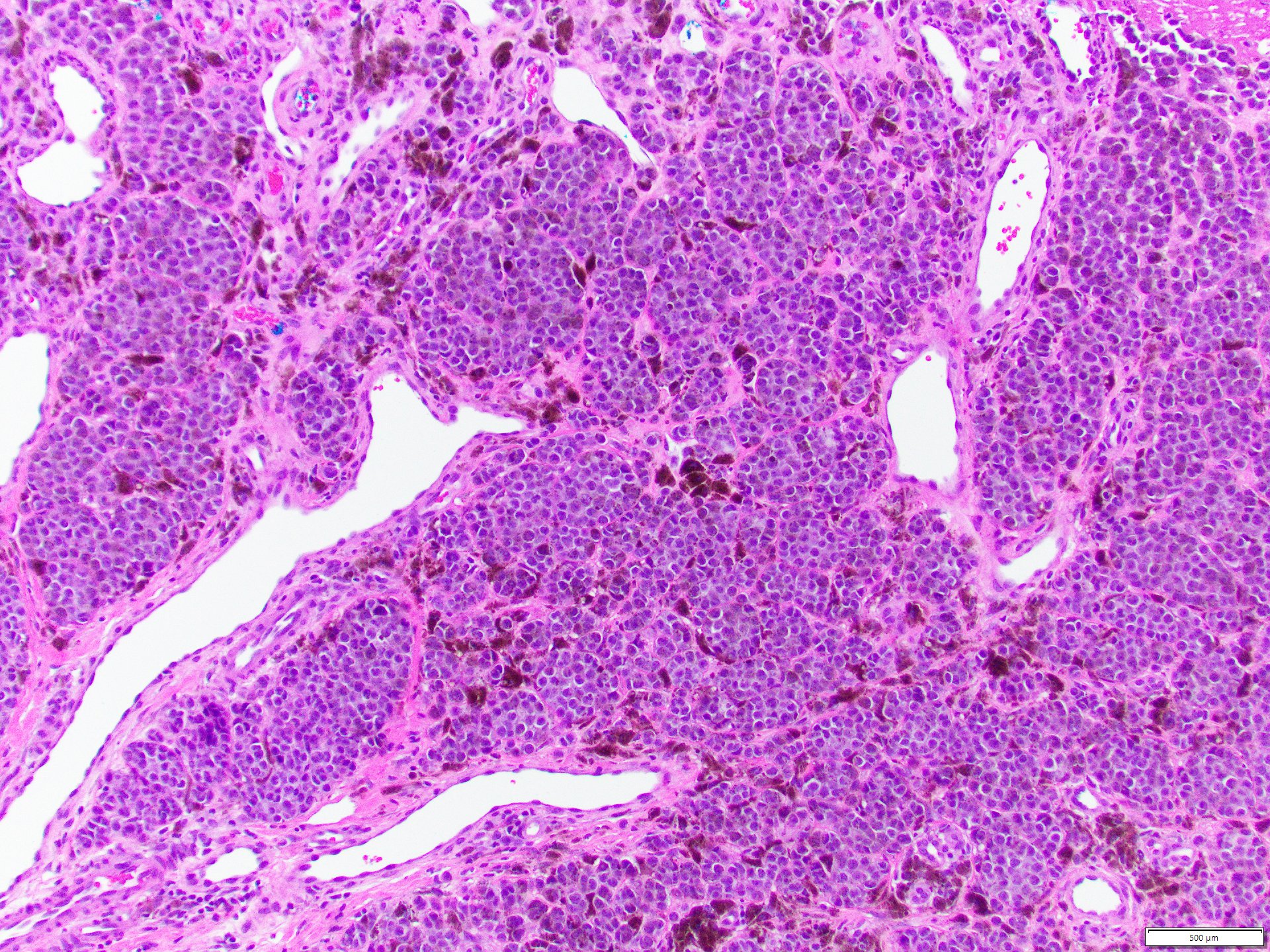Enlarged hyperchromatic melanocytes