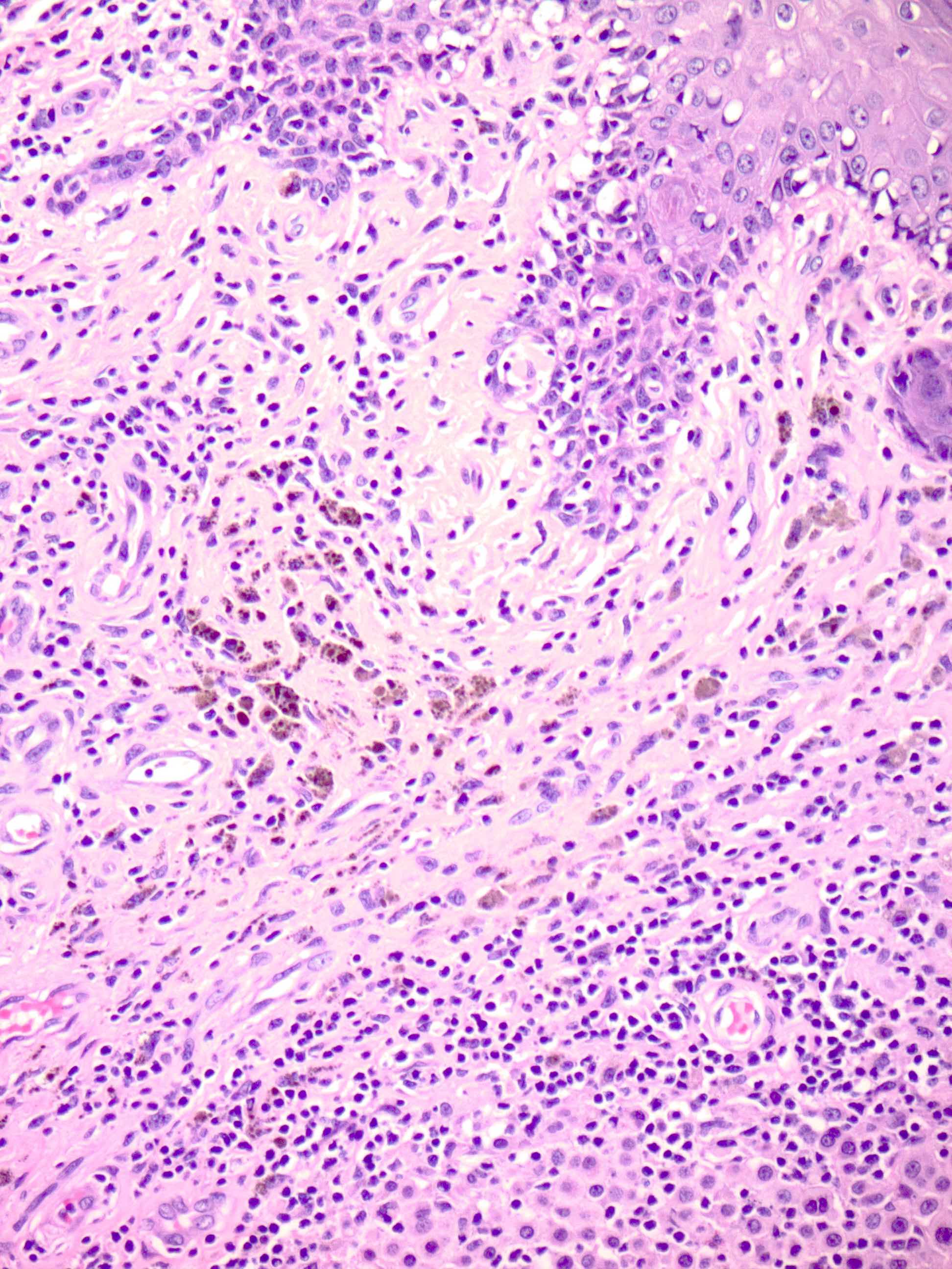 Regression with viable melanoma