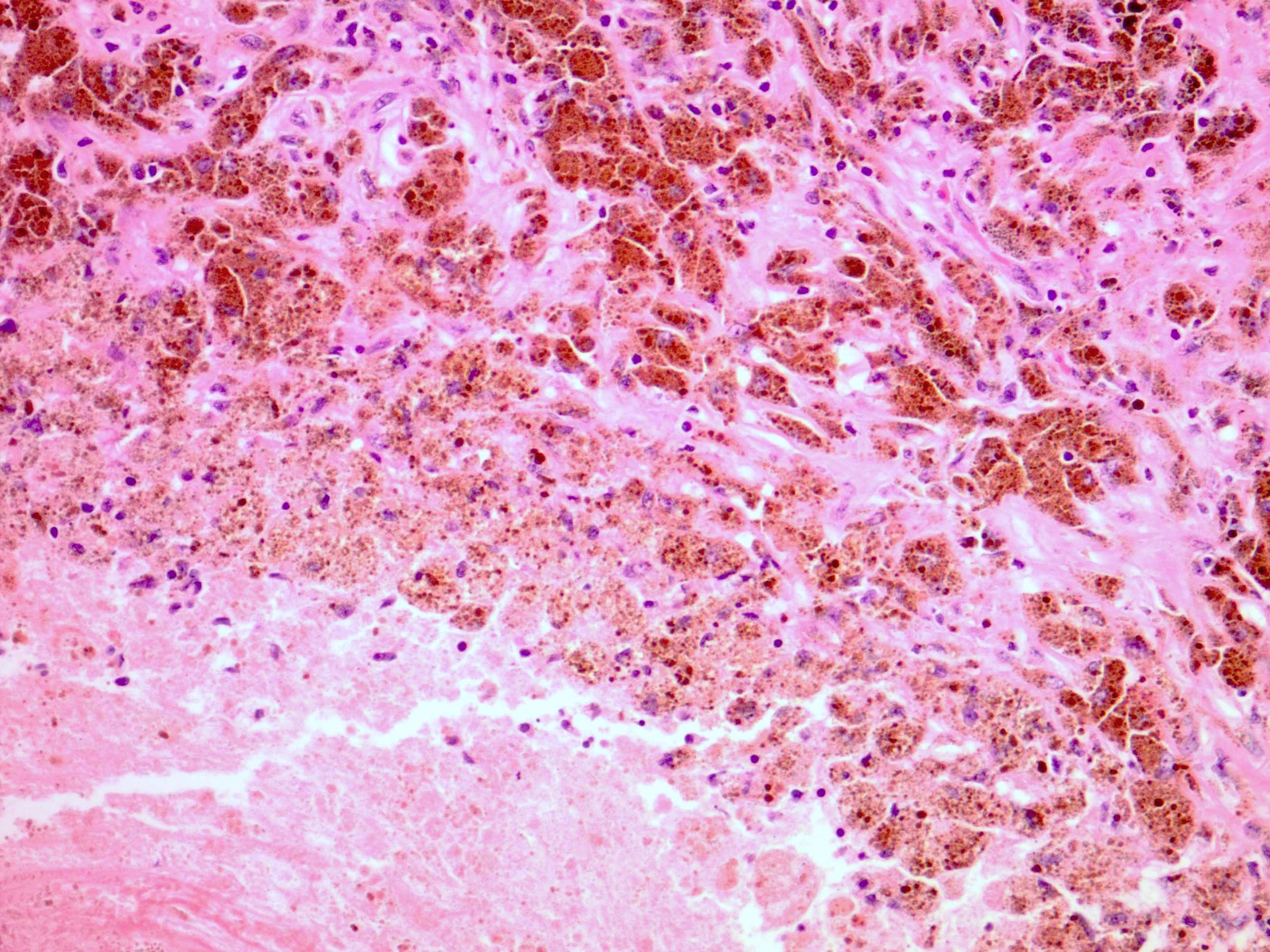 Tumor melanosis with necrosis