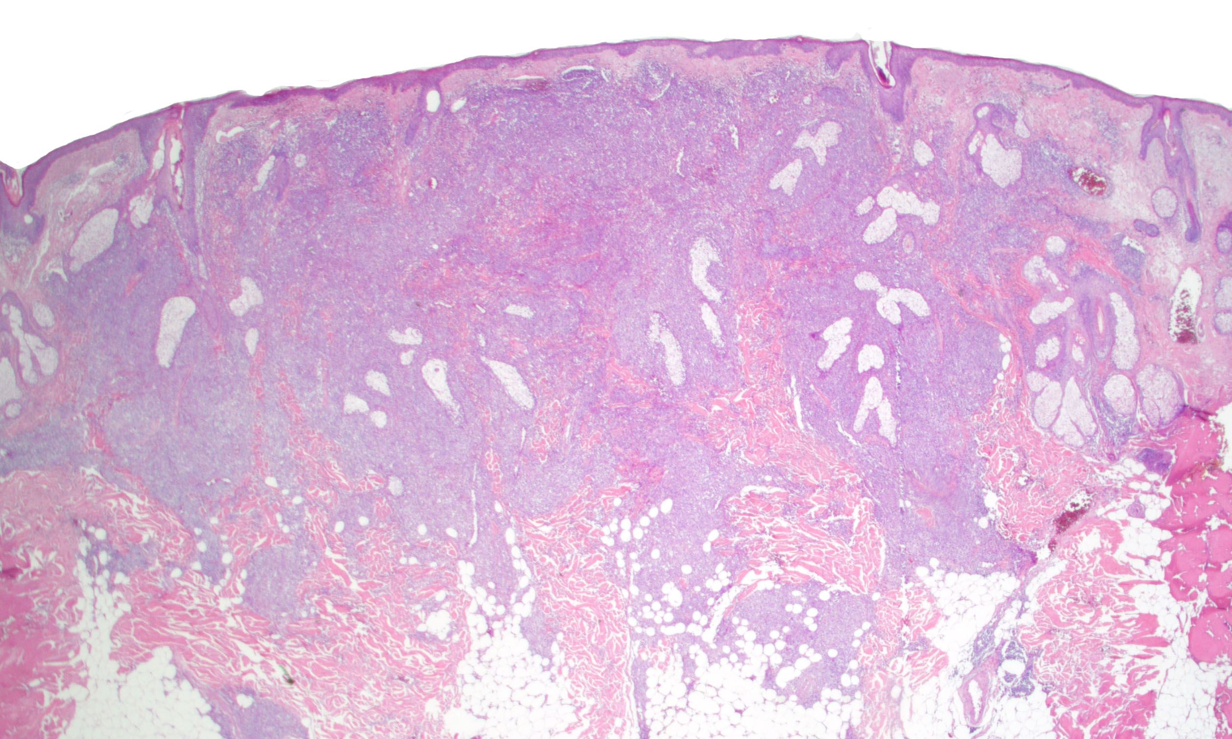 Lymphoid papillomatosis pathology outlines, Squamous cell papilloma histopathology