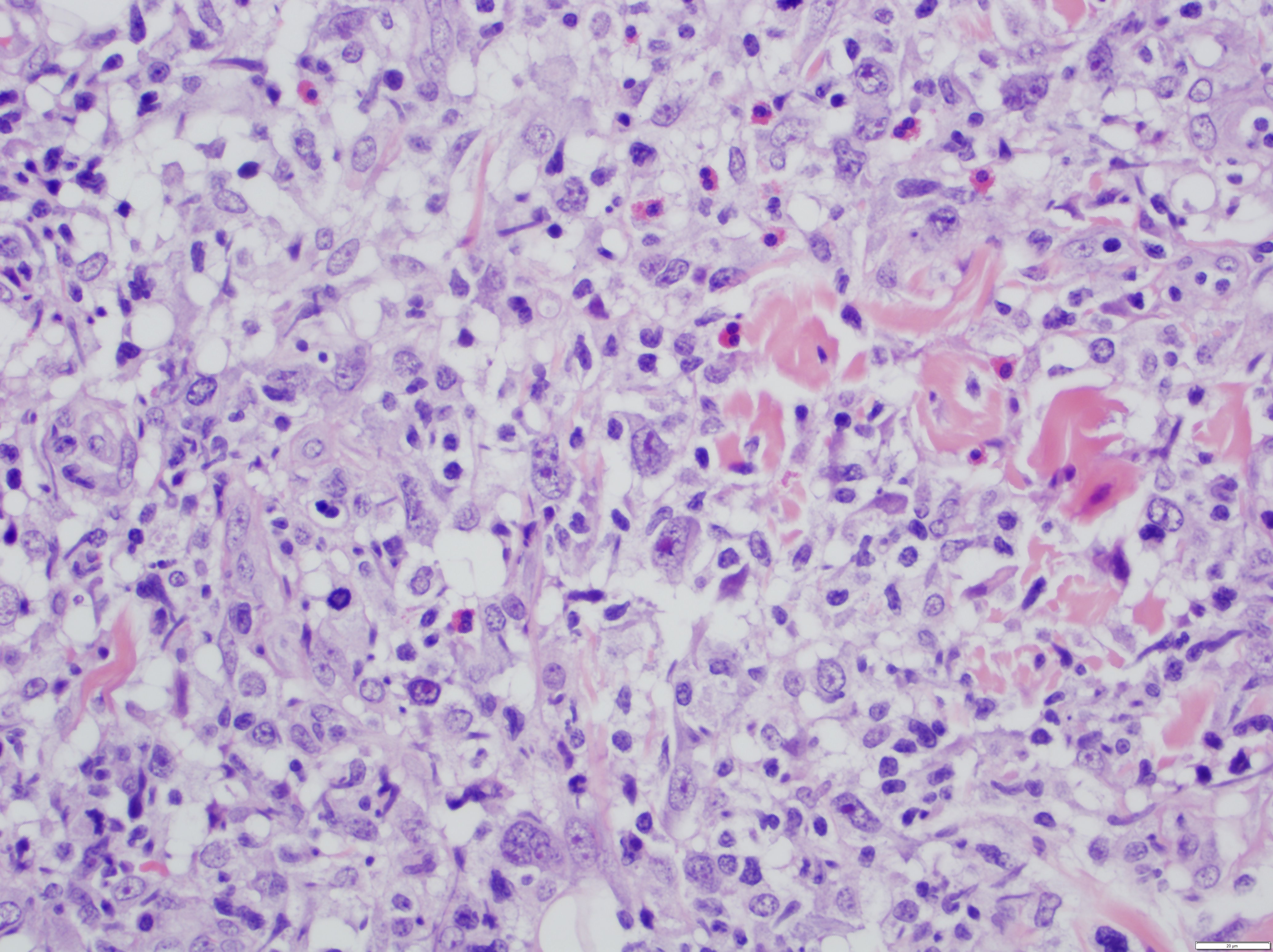 lymphomatoid papillomatosis pathology