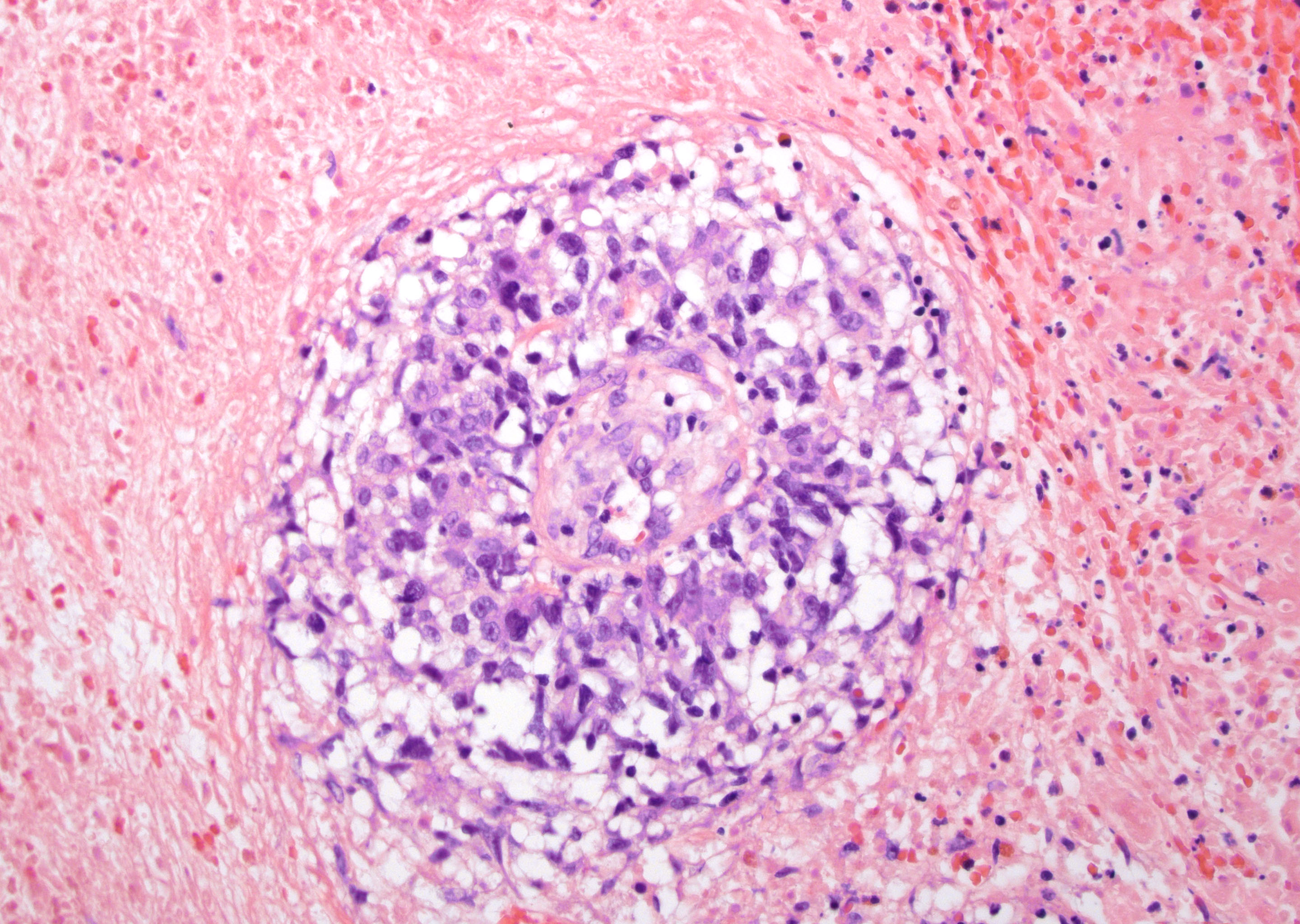 Lymphomatoid papillomatosis pathology - Lymphomatoid papillomatosis pathology