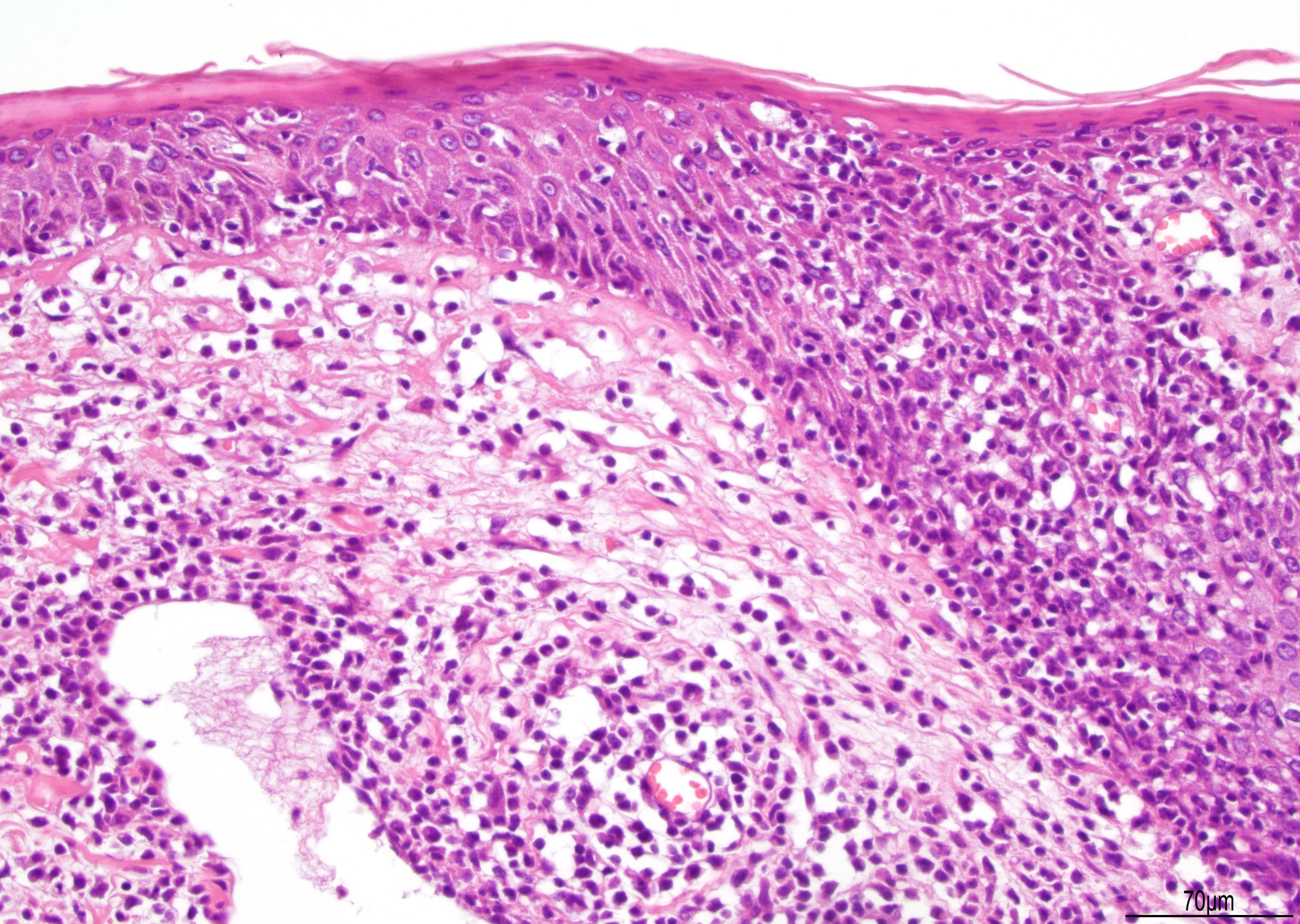 lymphoid papillomatosis pathology outlines