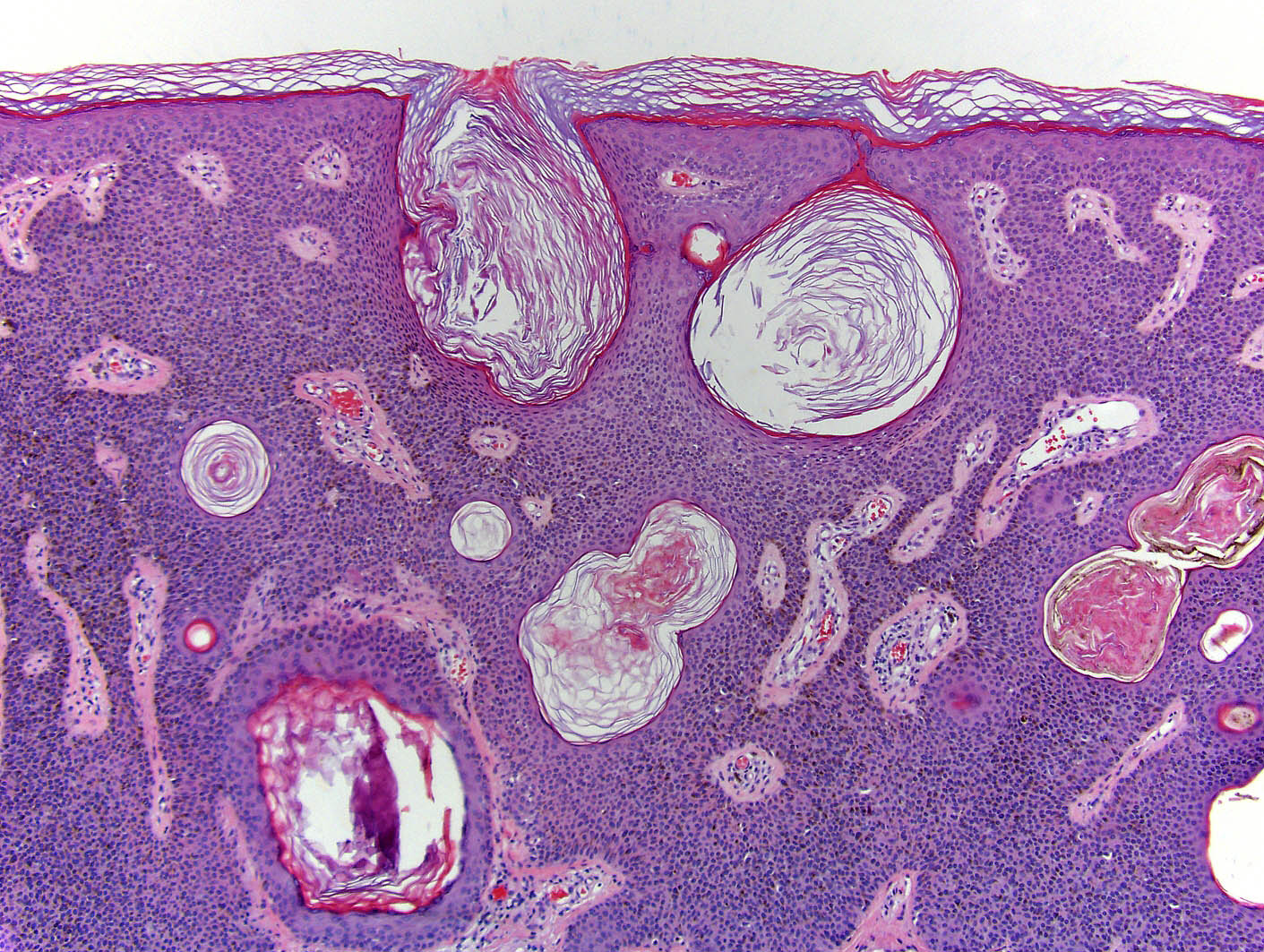 Papilloma of skin histology Papilloma skin pathology - bogdanvetu.ro