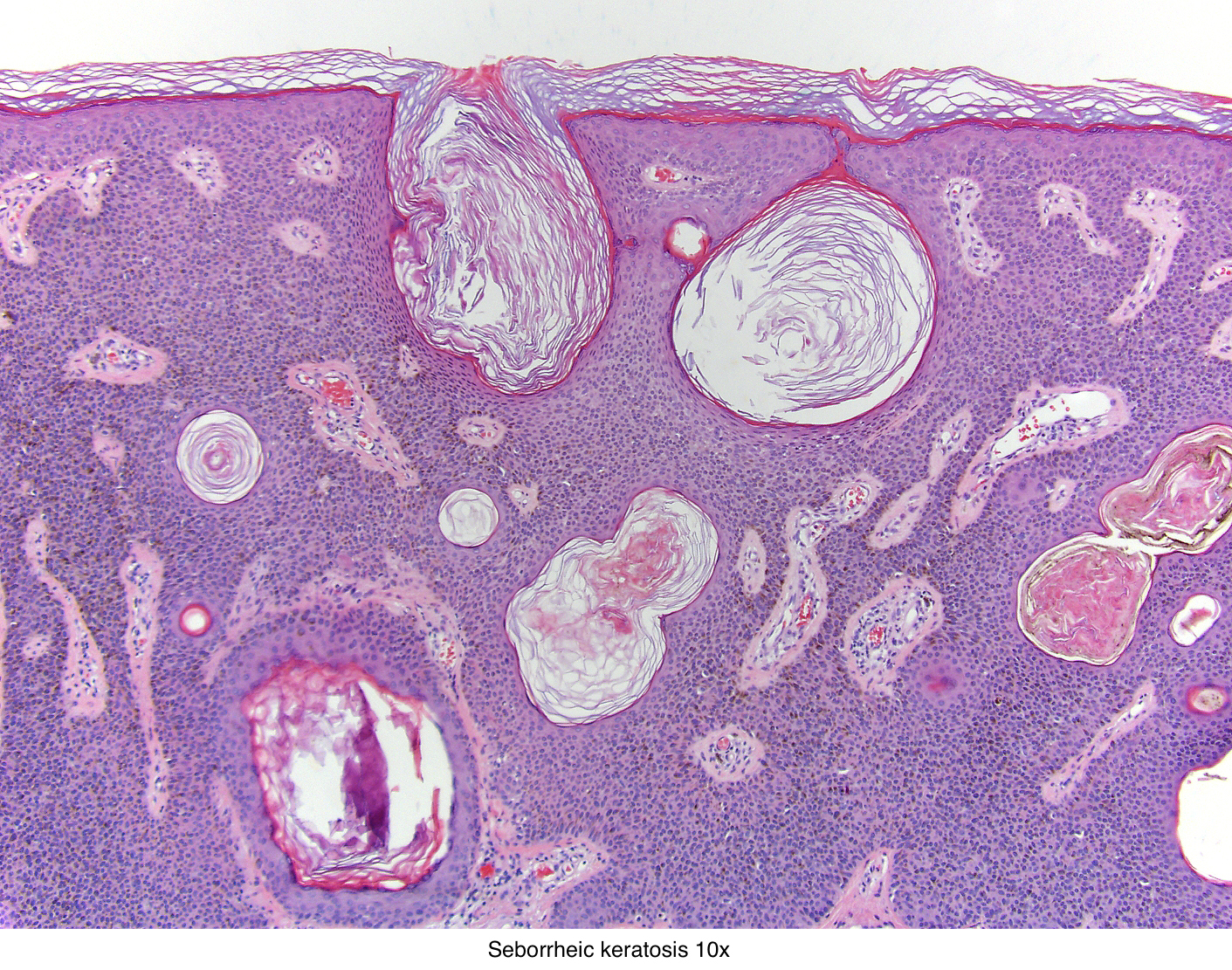 squamous papilloma vs seborrheic keratosis