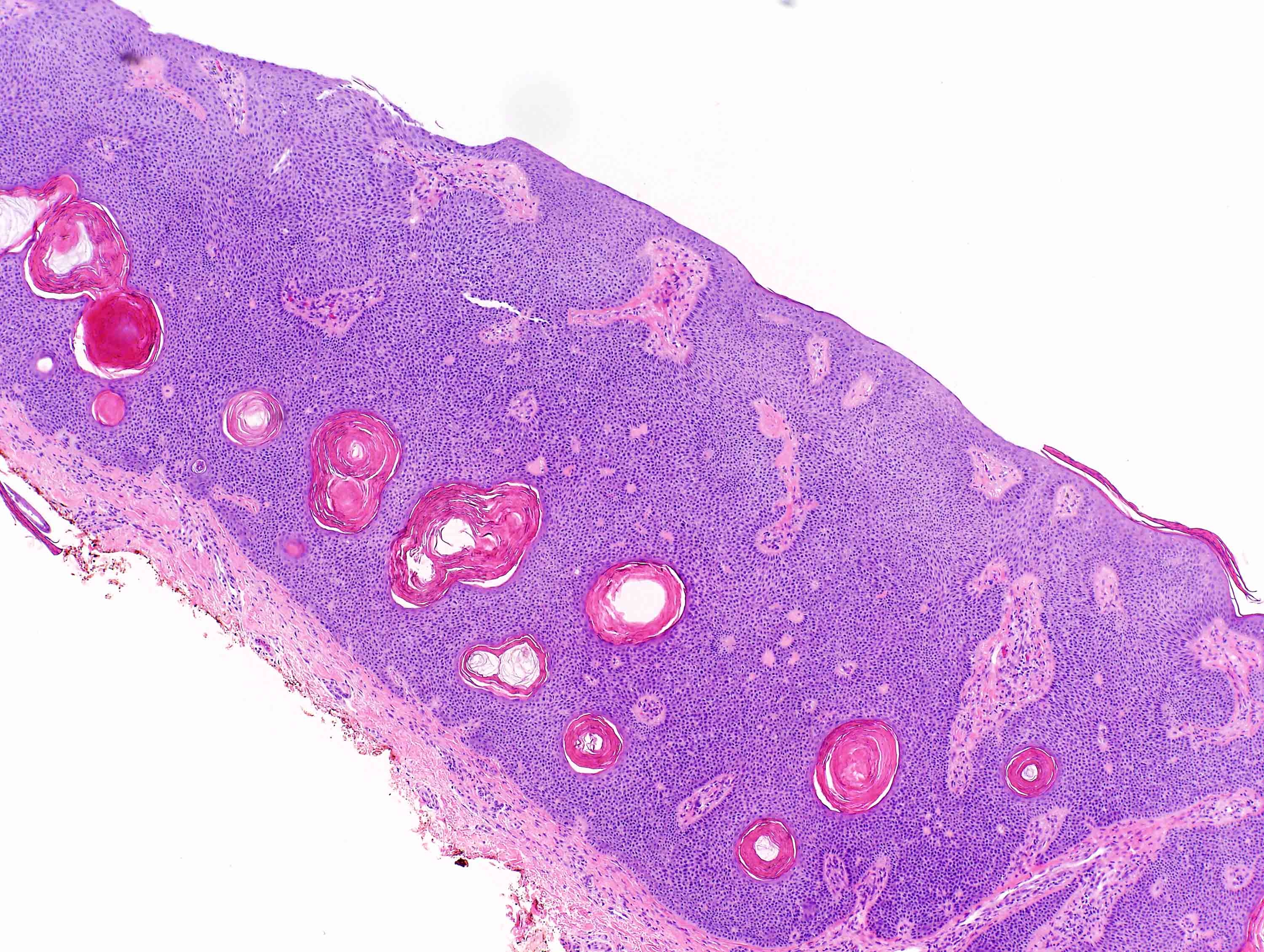 keratotic papilloma pathology outlines