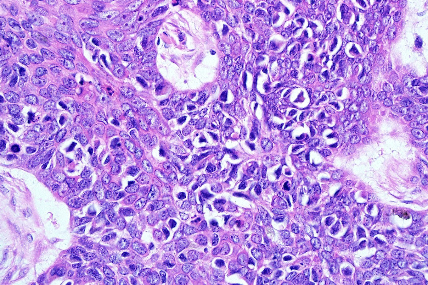 Basomelanocytic tumor