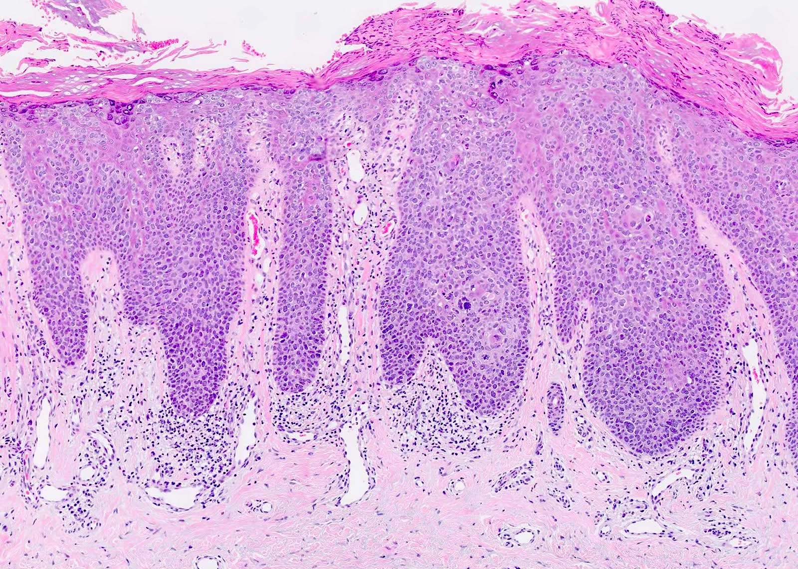 Squamous Cell Carcinoma In Situ Histology