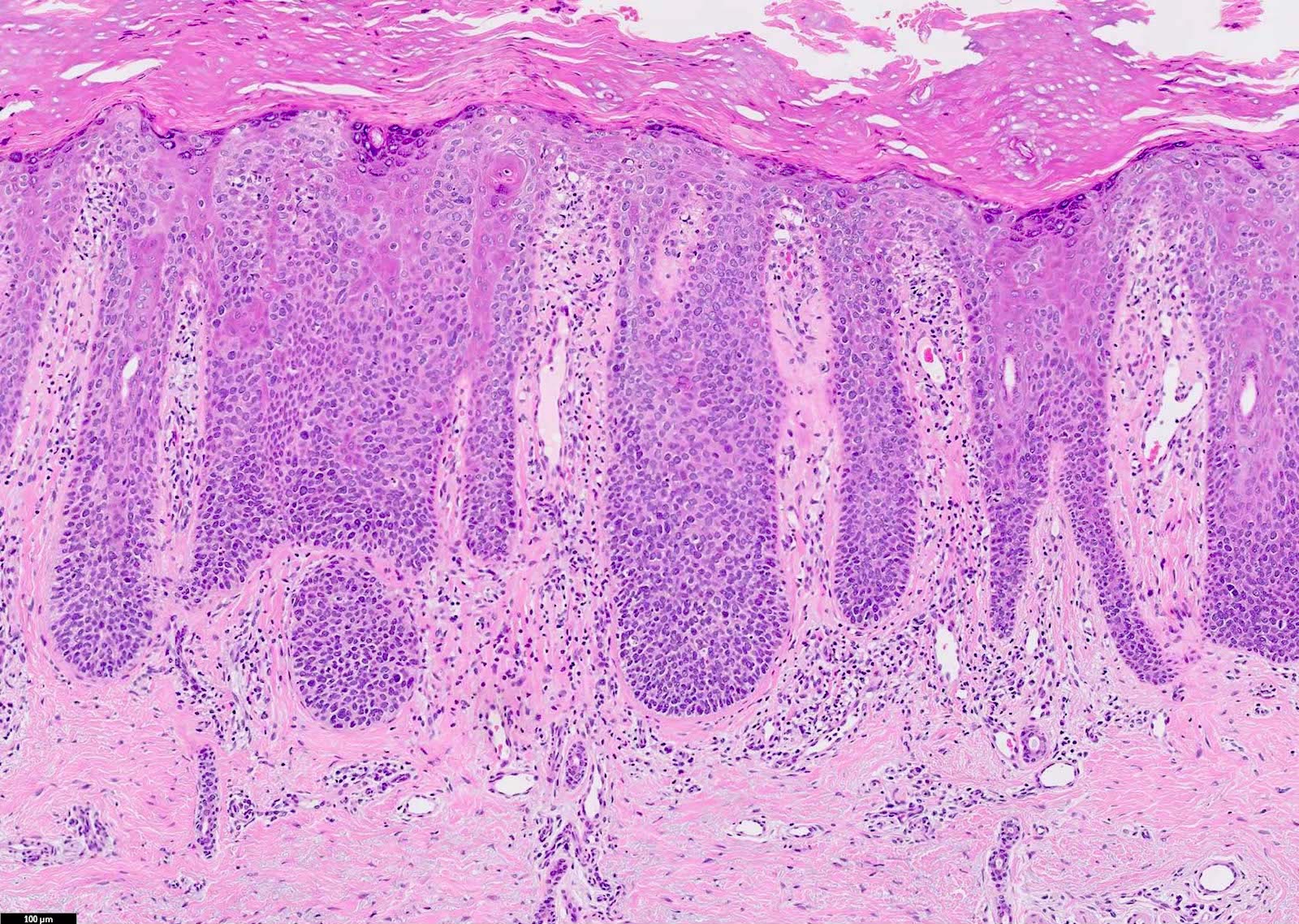 squamous cell carcinoma in situ histology