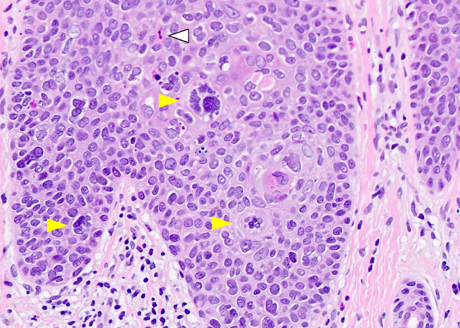 squamous cell carcinoma in situ histology