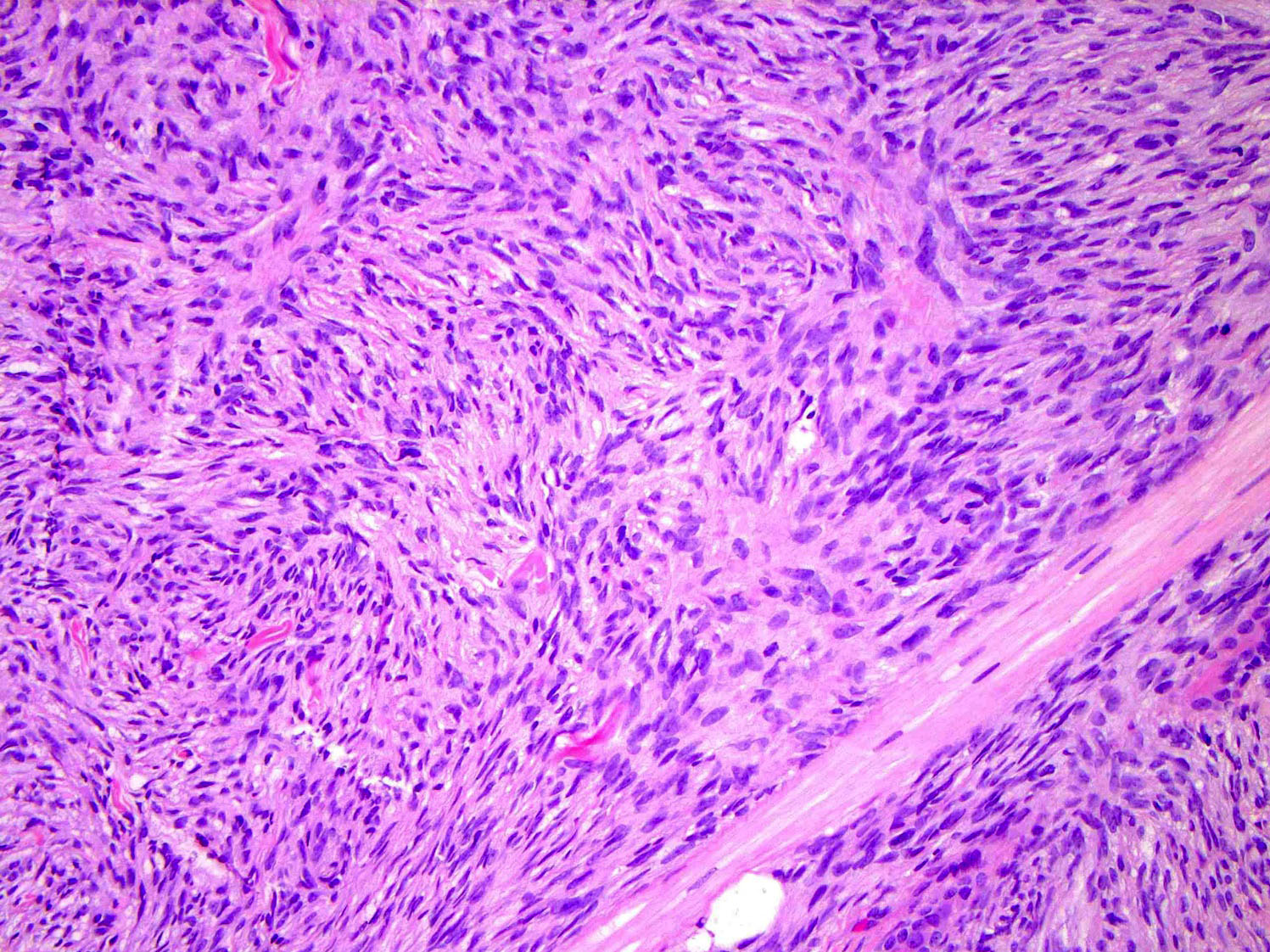 Pathology Outlines Dermatofibrosarcoma Protuberans Dfsp