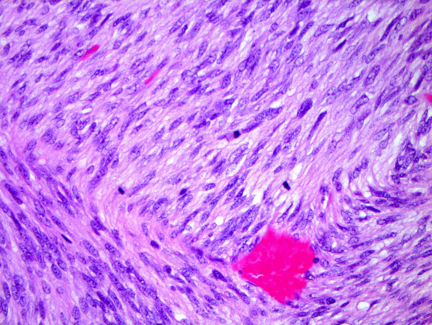 Pathology Outlines Dermatofibrosarcoma Protuberans Dfsp
