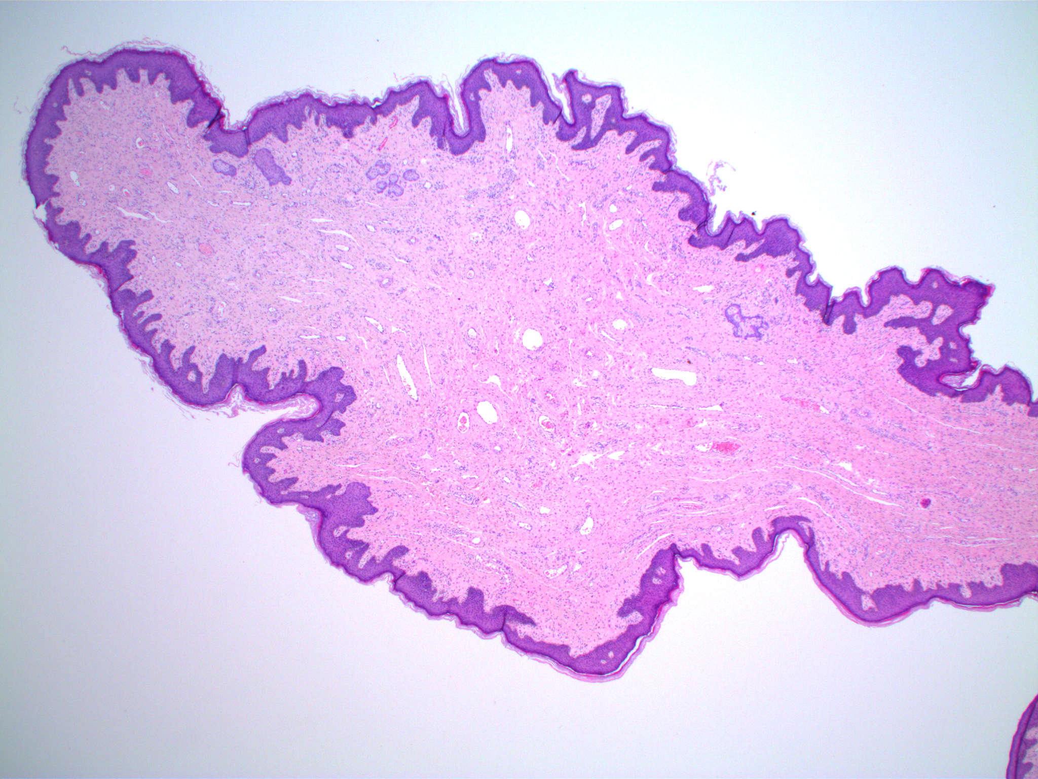 What causes fibroepithelial papilloma Fibroepithelial papillomas