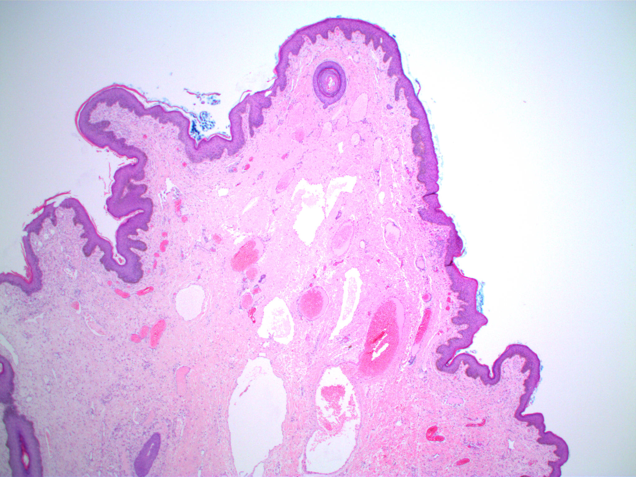 papilloma fibroepithelial