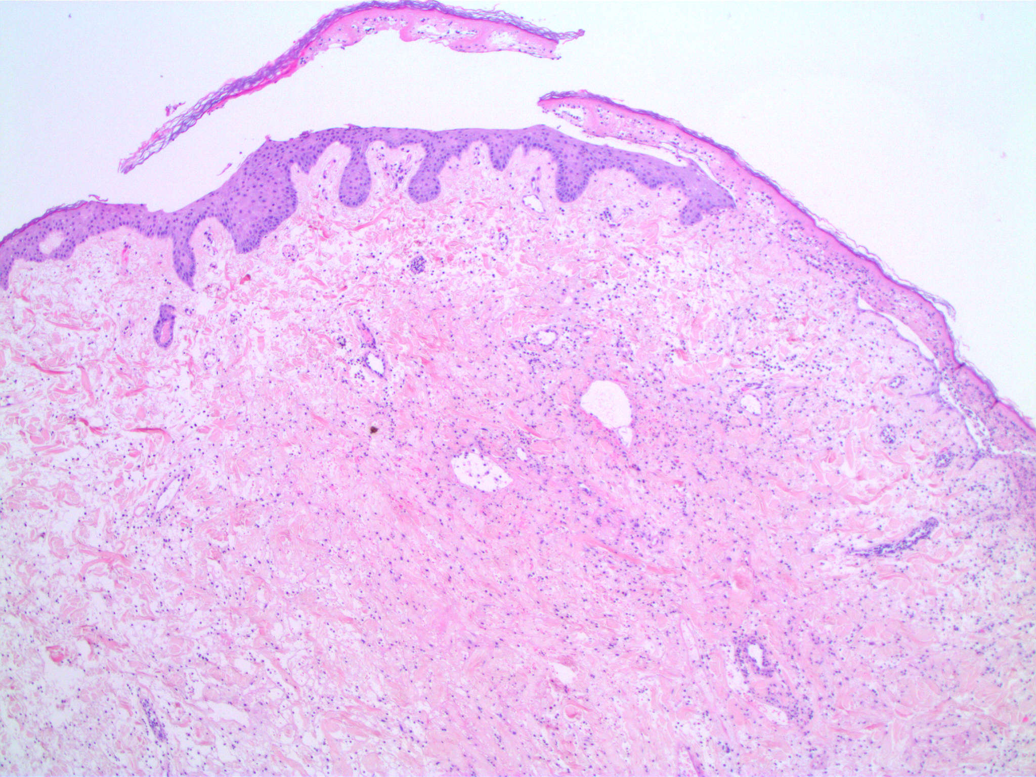 Squamous papilloma vs fibroepithelial polyp