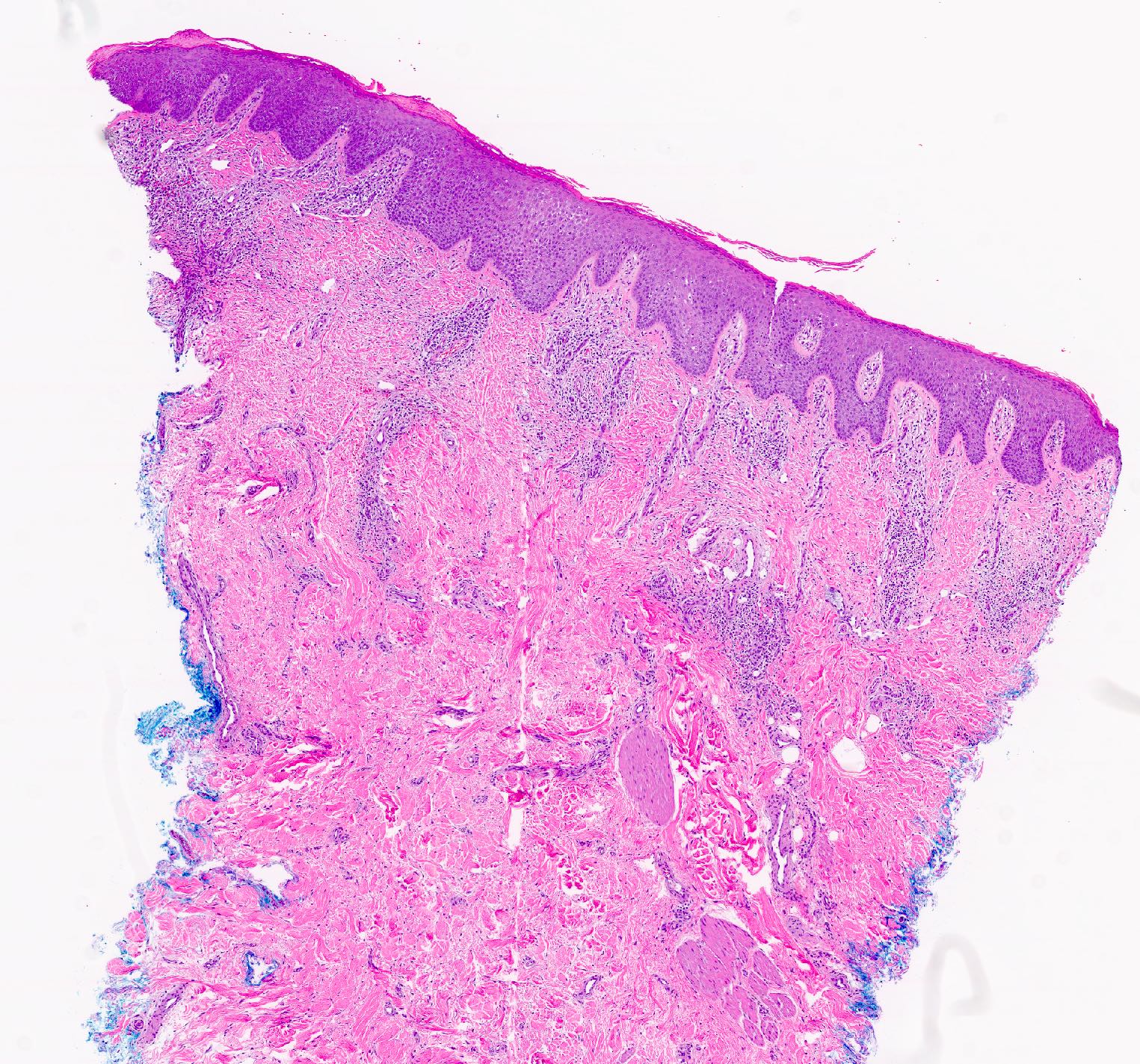 Cutaneous lymphoid hyperplasia simulating mycosis fungoides