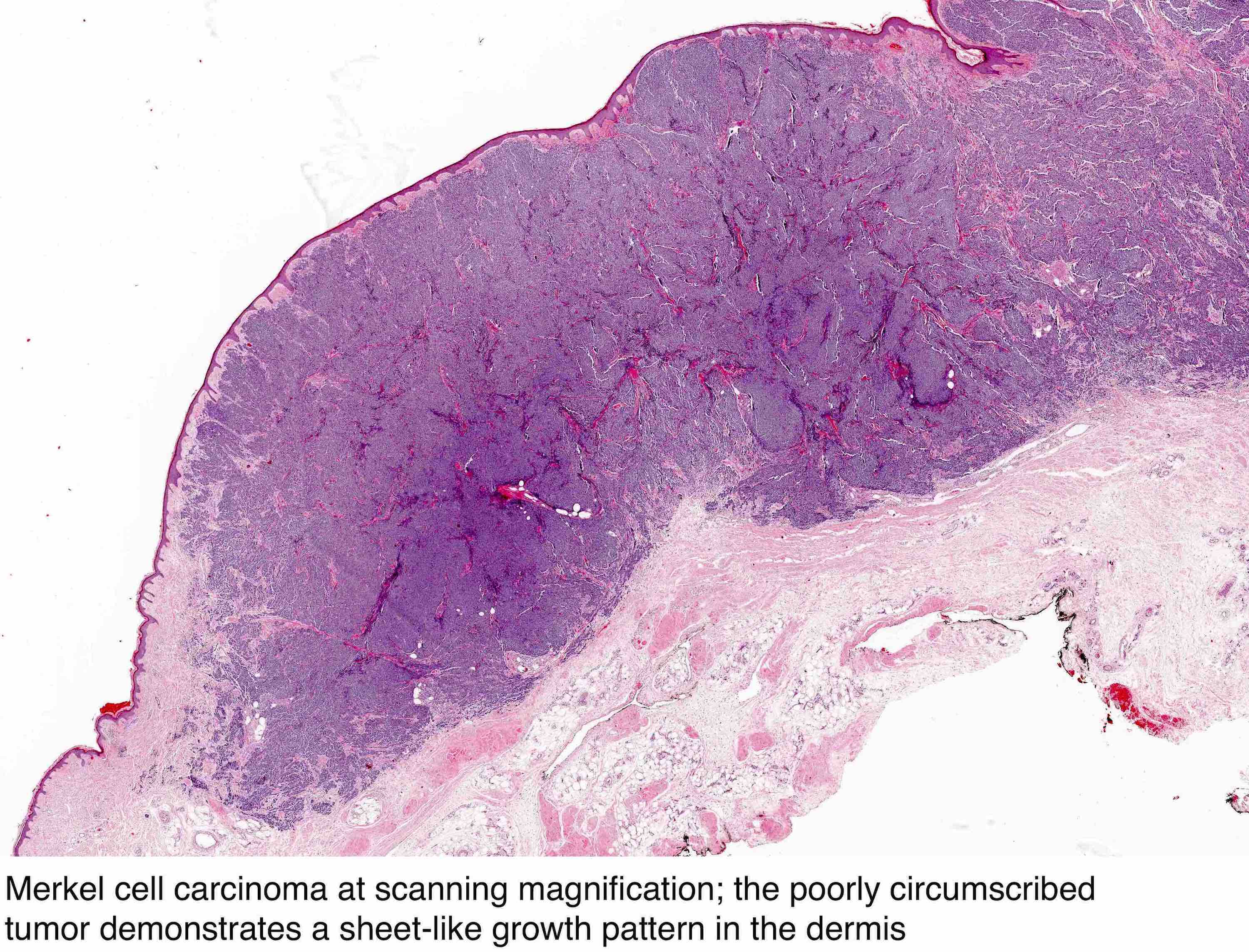 Merkel Cell Carcinoma Histology File Merkel Cell Carcinoma Intermed