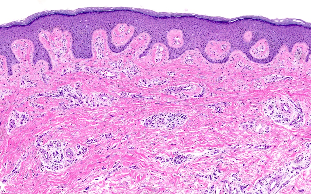 Superficial papillary dermal fibrosis