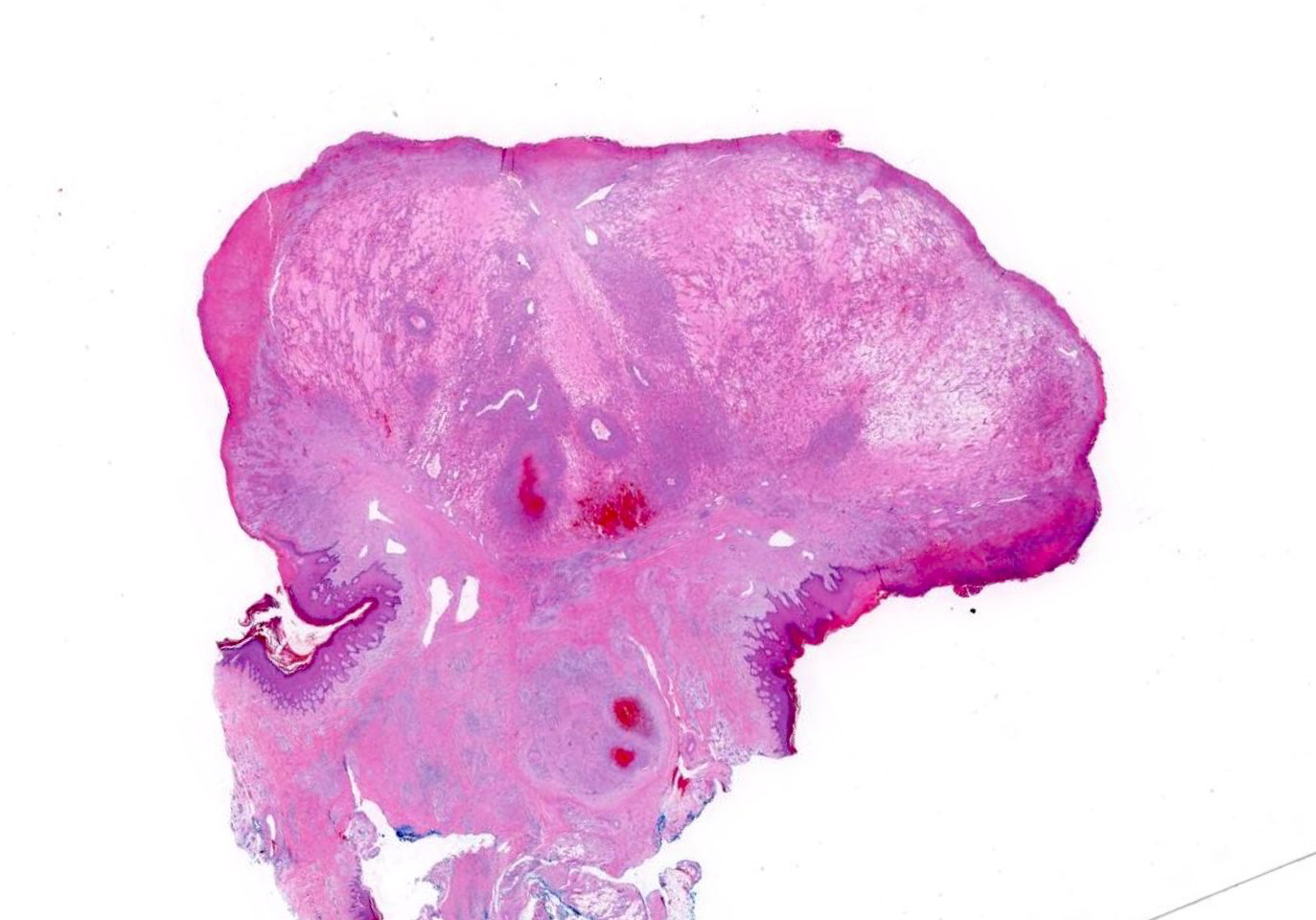 Lobular capillary hemangioma