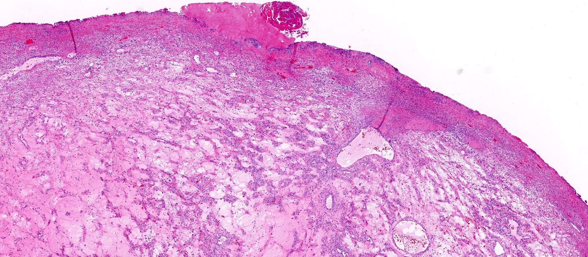 Lobular capillary hemangioma