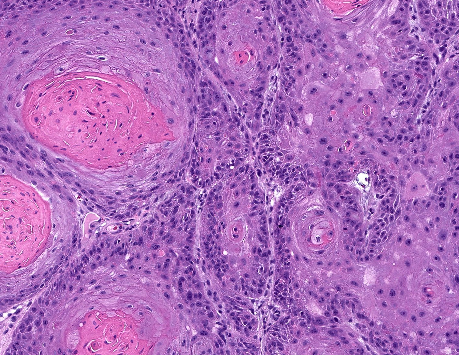 squamous cell carcinoma in situ histology