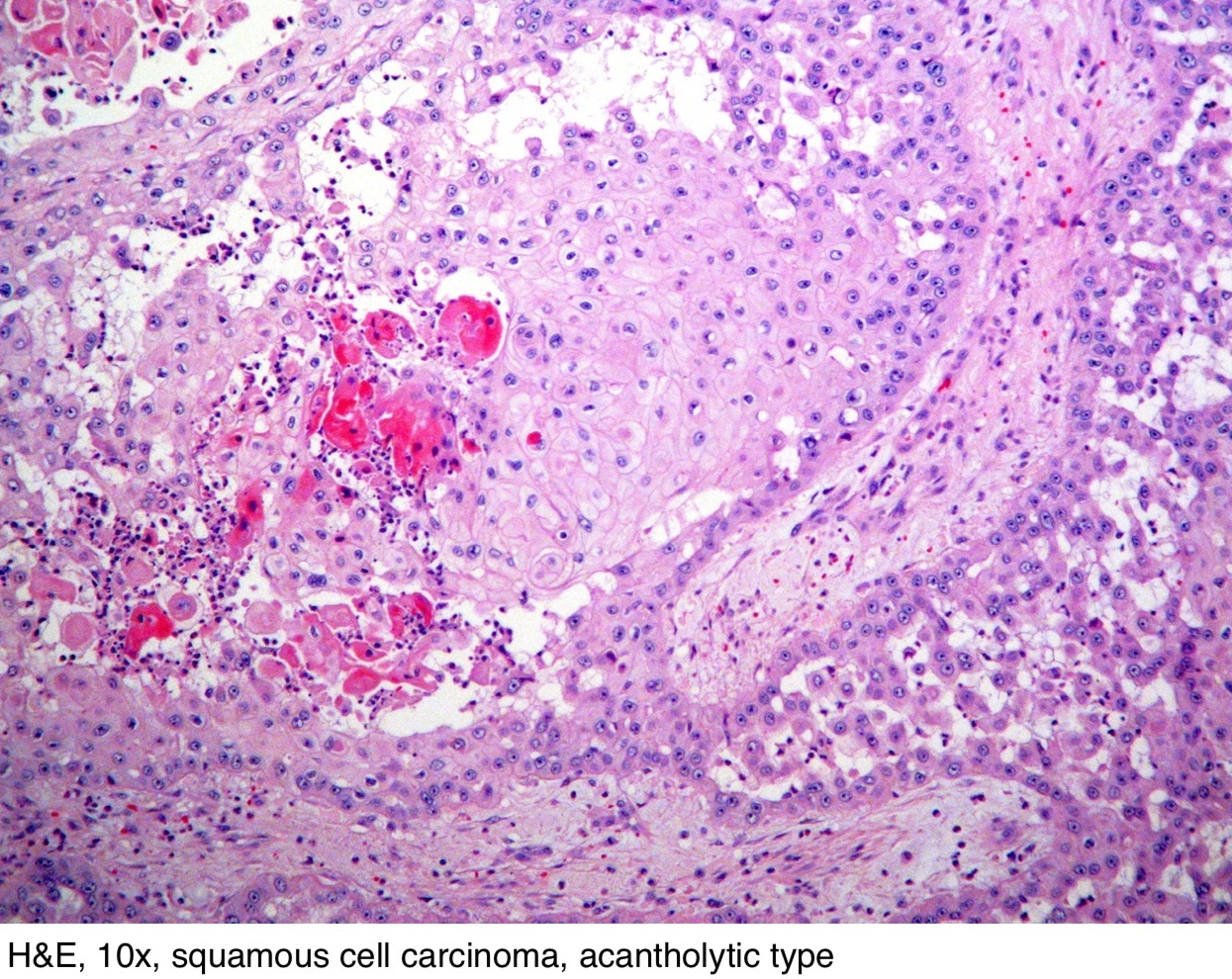 Survival rate of squamous cell carcinoma in the lymph node