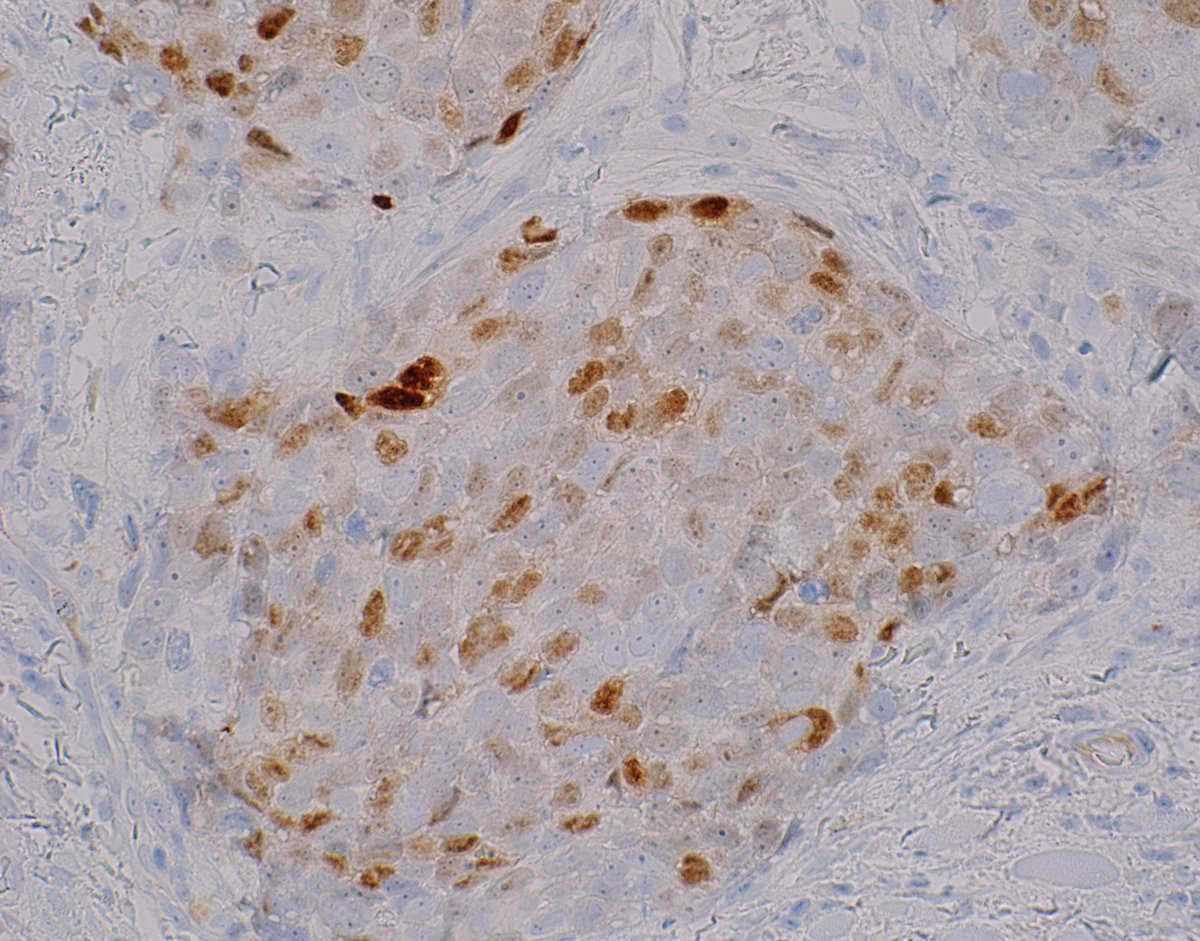 Androgen receptor nuclear staining