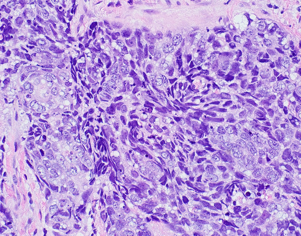 Atypical basaloid cells