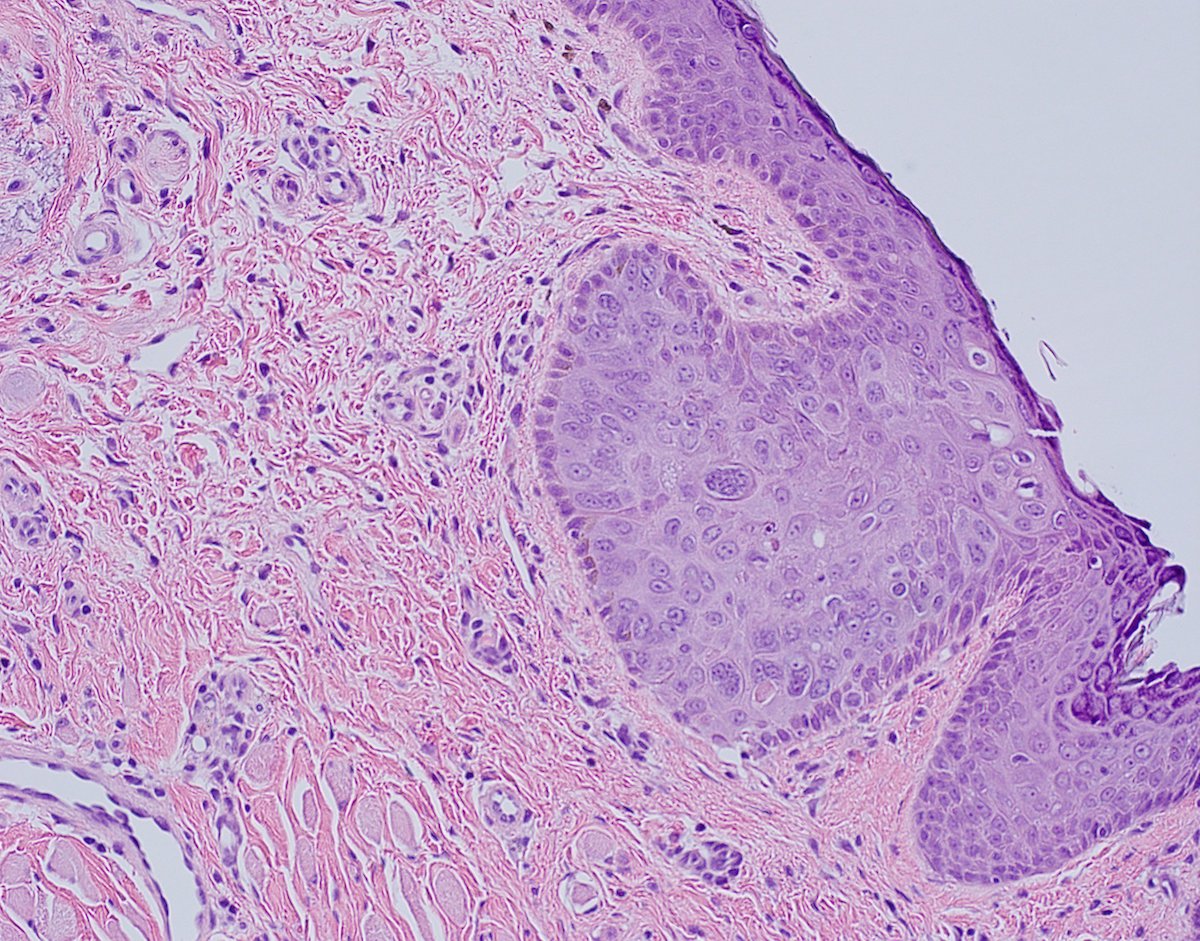 Intraepidermal sebaceous carcinoma