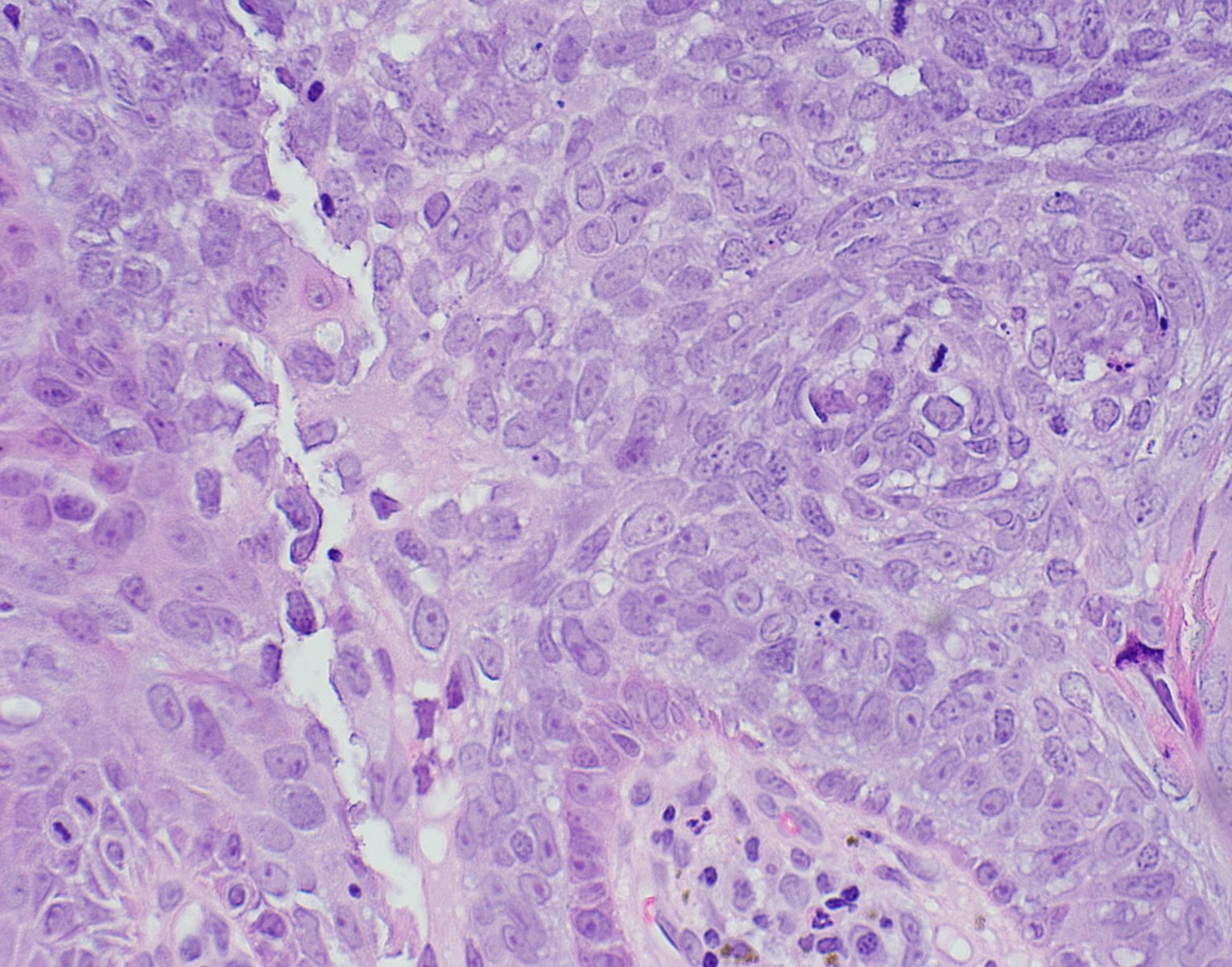 Atypical basaloid cells within the epidermis
