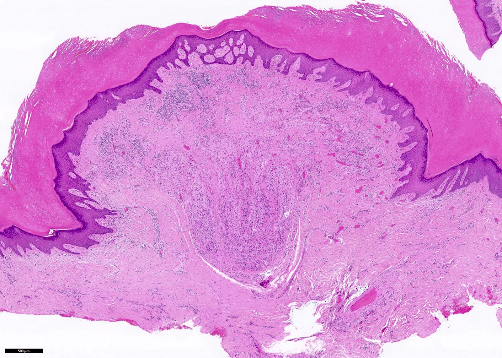 Pathology Outlines Supernumerary digit