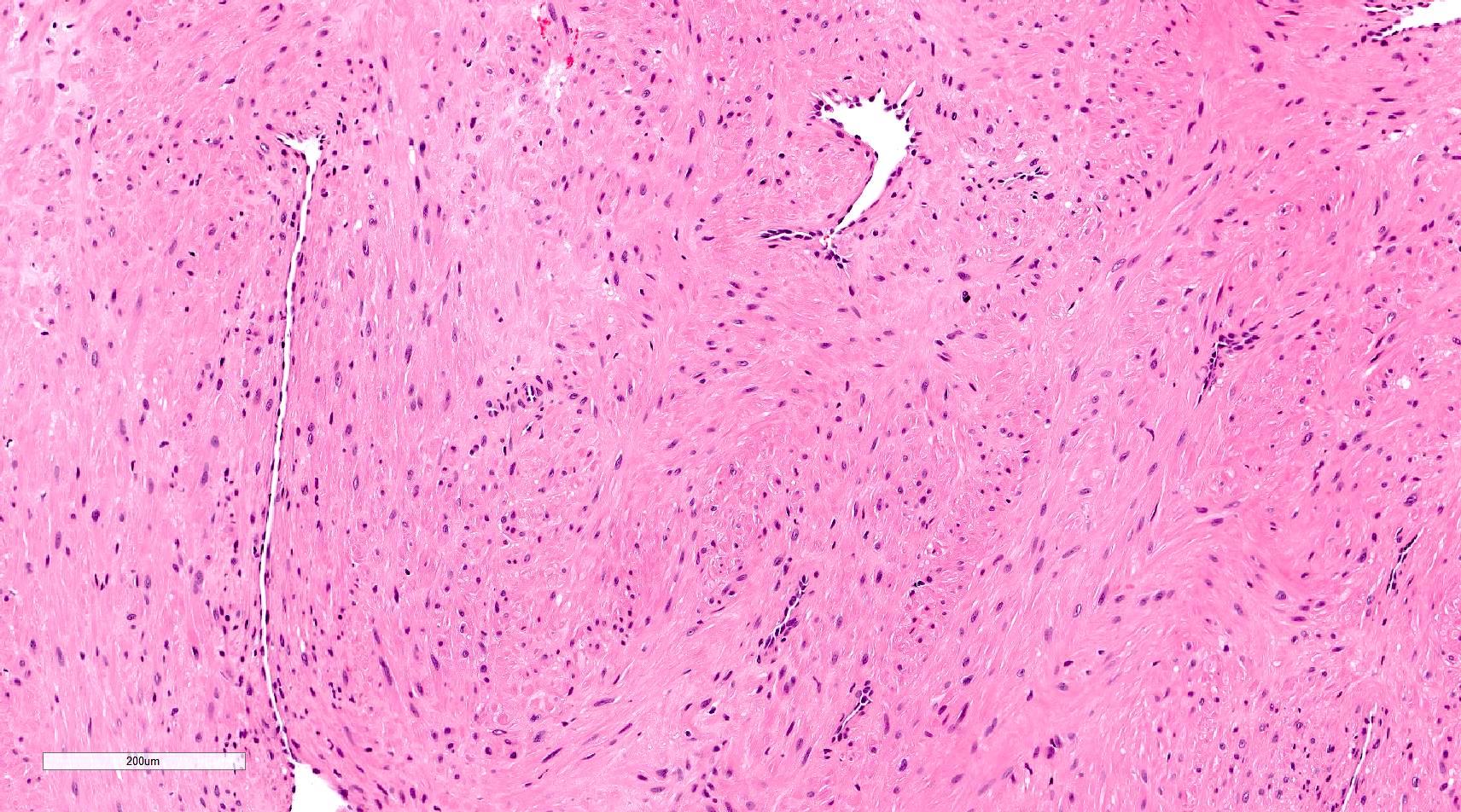 Gross image showing dilated and thick-walled blood vessels with