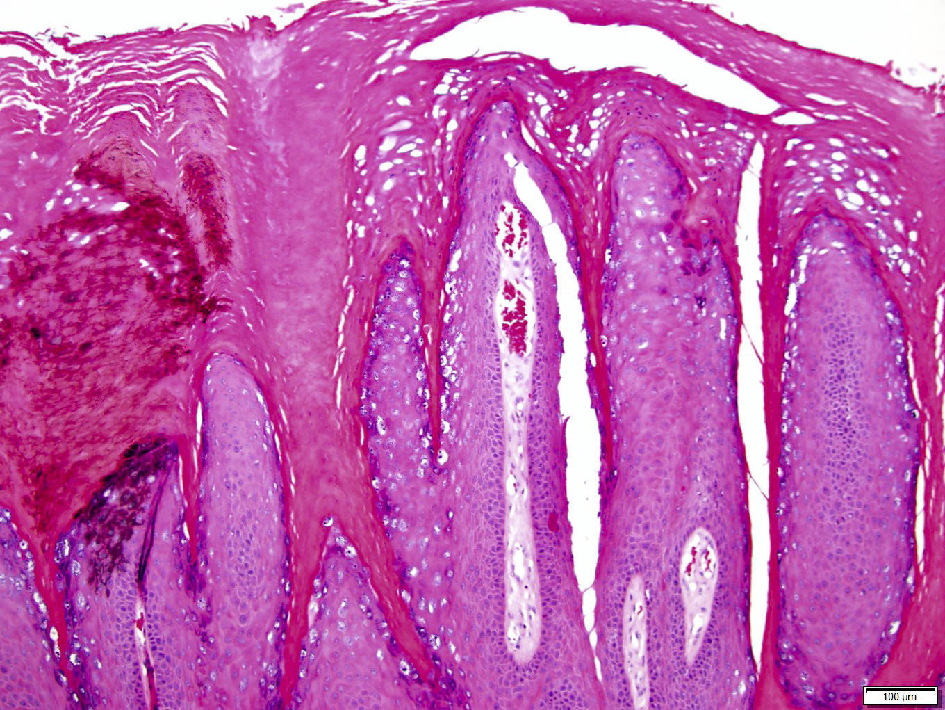 Papilloma skin pathology outline, Hpv wart histology