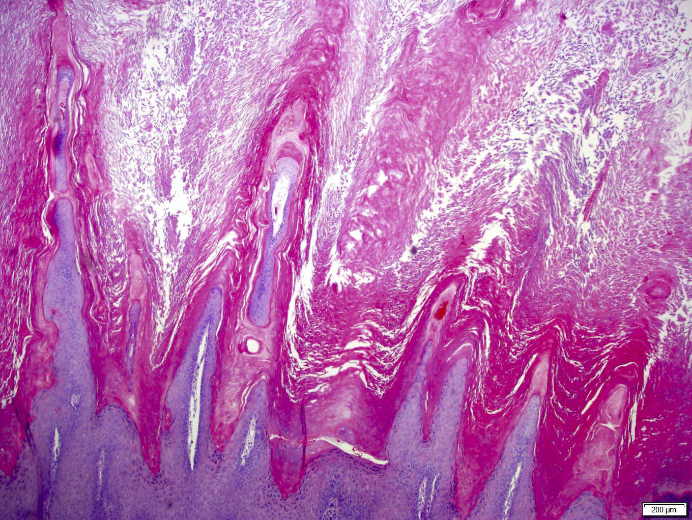 papillomatosis skin pathology outlines