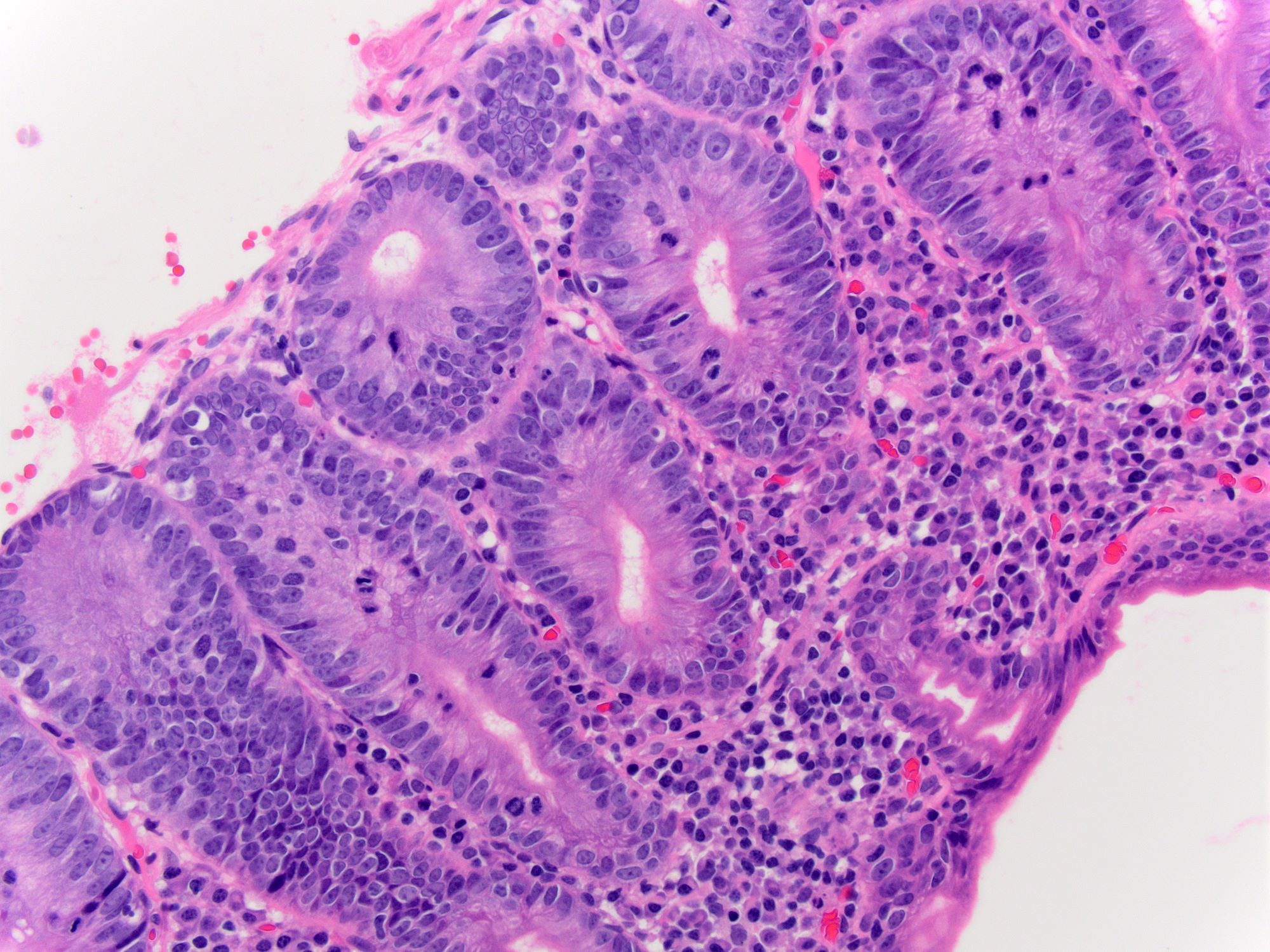 Pathology Outlines - Autoimmune enteropathy