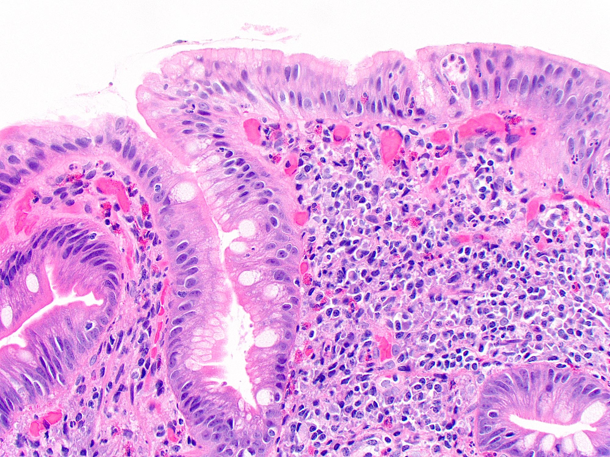 Helicobacter infection in duodenum