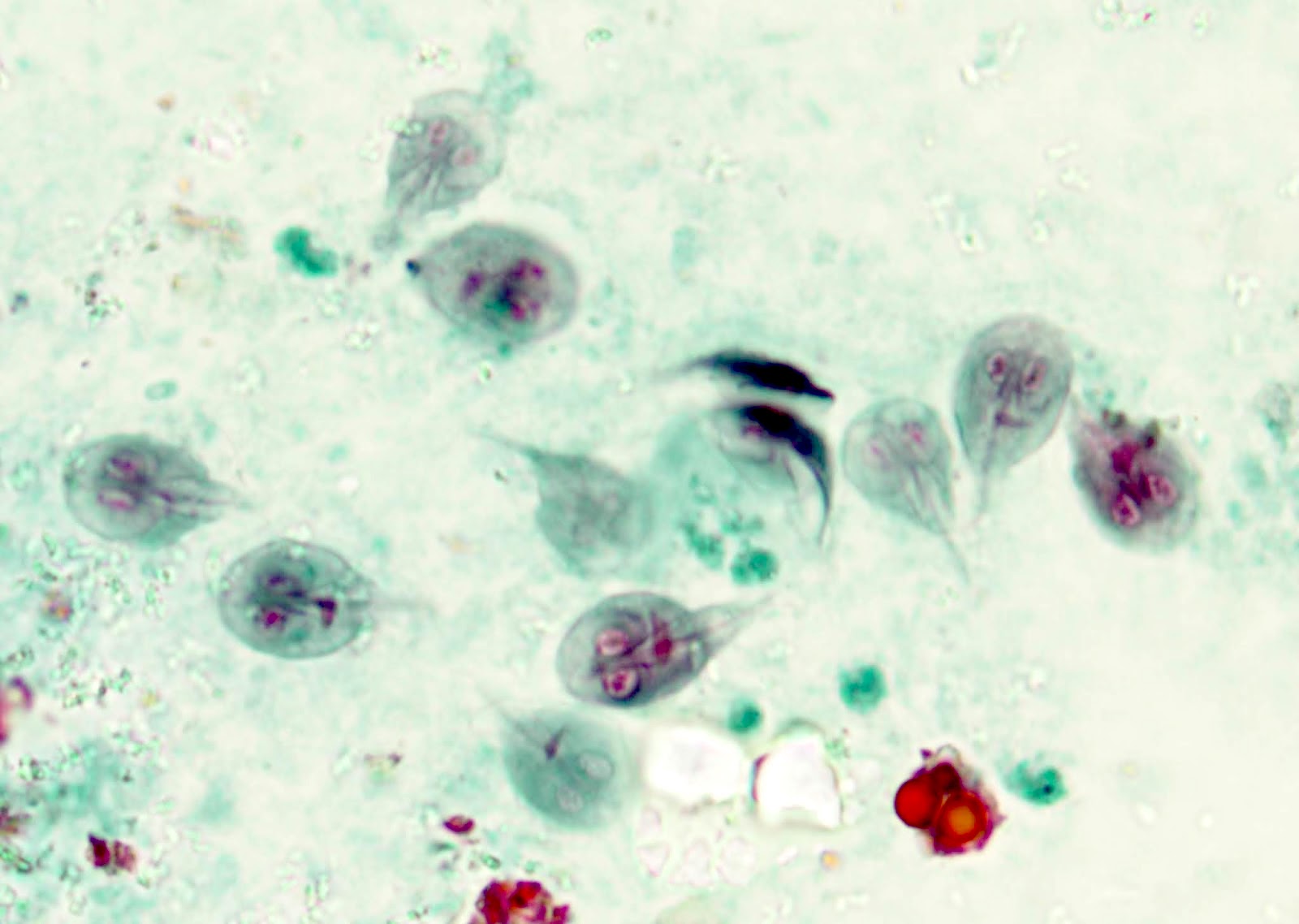 giardiasis duodenum pathology outlines)