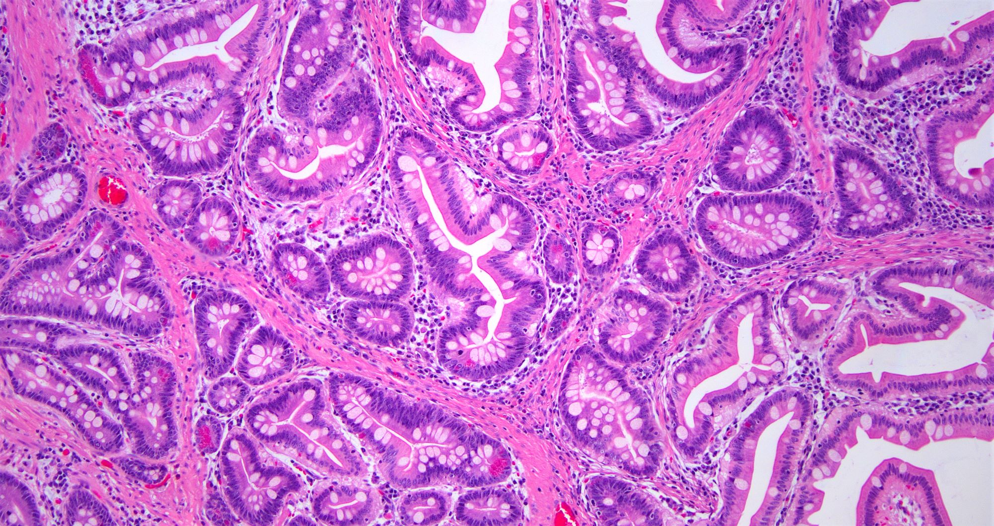 Bland epithelial component in PJP