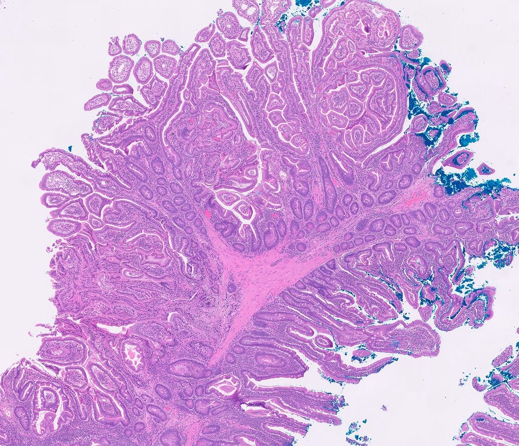 Peutz-Jeghers polyp