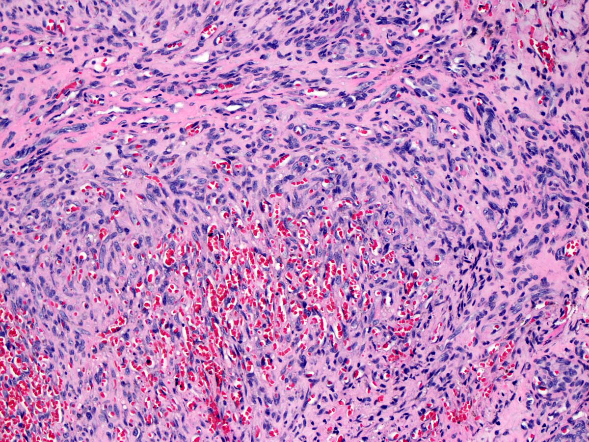 Atypical spindled cells