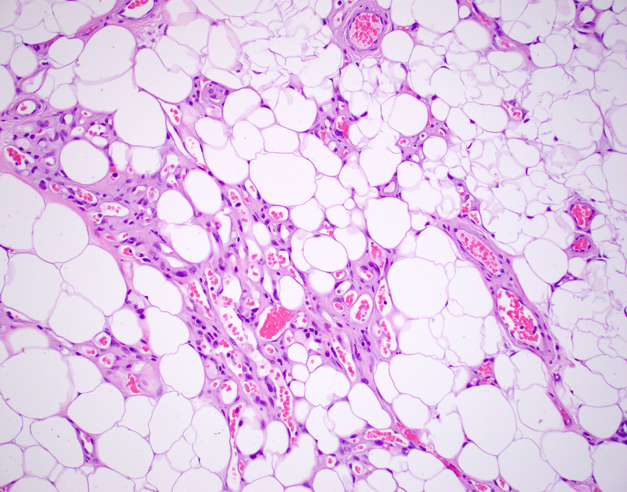 Mature adipose tissue with vessels